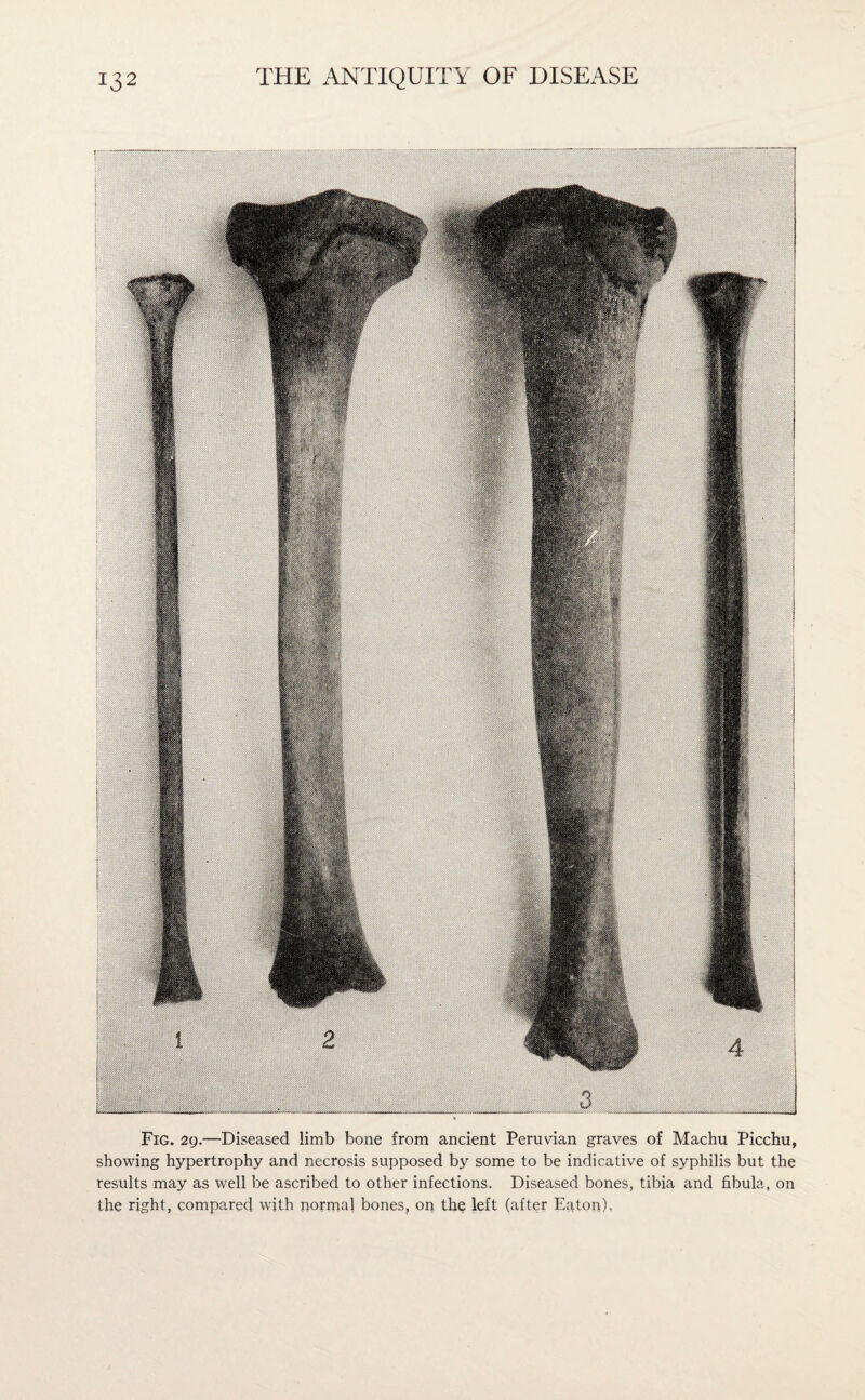 Fig. 29.—Diseased limb bone from ancient Peruvian graves of Machu Picchu, showing hypertrophy and necrosis supposed by some to be indicative of syphilis but the results may as well be ascribed to other infections. Diseased bones, tibia and fibula, on the right, compared with normal bones, on the left (after Eaton).