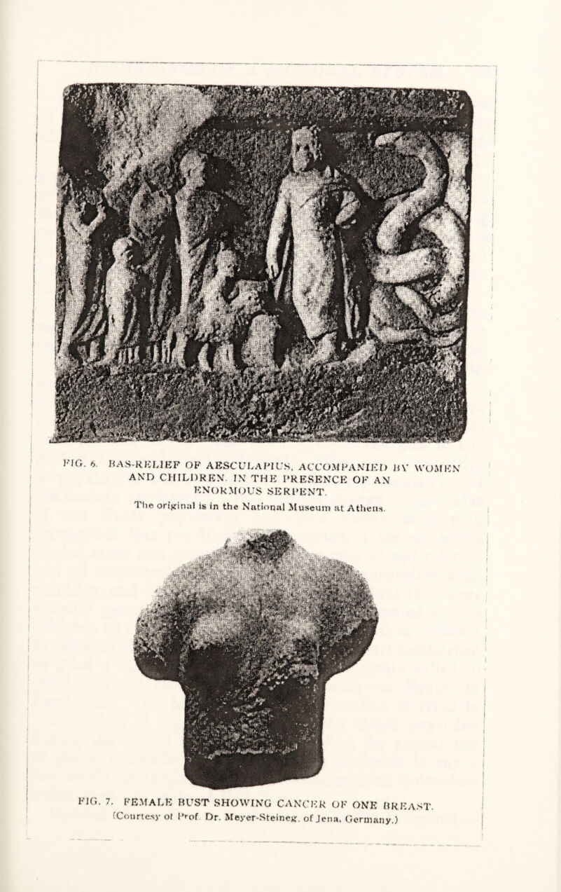 ]nG- 6 BAS-RELIEF OF AESCULAPIUS, ACCOMPANIED HV WOMEN AND CHILDREN. IN THE PRESENCE OF AN KNOkMOUSSERPENT. I lie original is in the National Museum at Athens. FIG. 7. FEMALE BUST SHOWING CANCER OF ONE BREAST, f Courtesy ol Prof. Dr. Meyer-Steineg. of Jen*» Germany.)