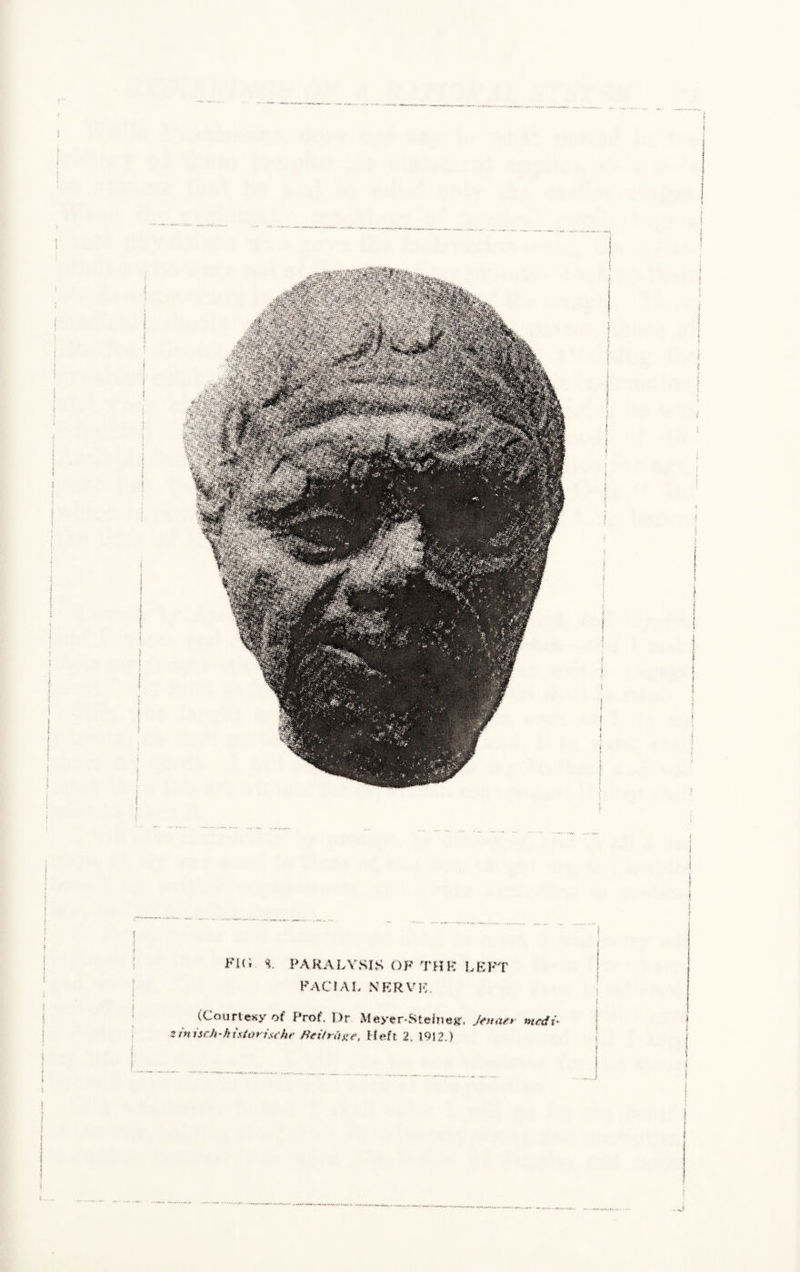 ; i f \ i t * I i ! | £ ? \ i FHi 1 PARALYSIS OF THK LEFT FACIAL NERVE. (Courtesy ot Prof, 1)r Meyer-Stehieg1, Jtnatr ntcdi* 5 Atiseh-k{starin'hr ffeitraxe, Heft 2. 1912.) t |_