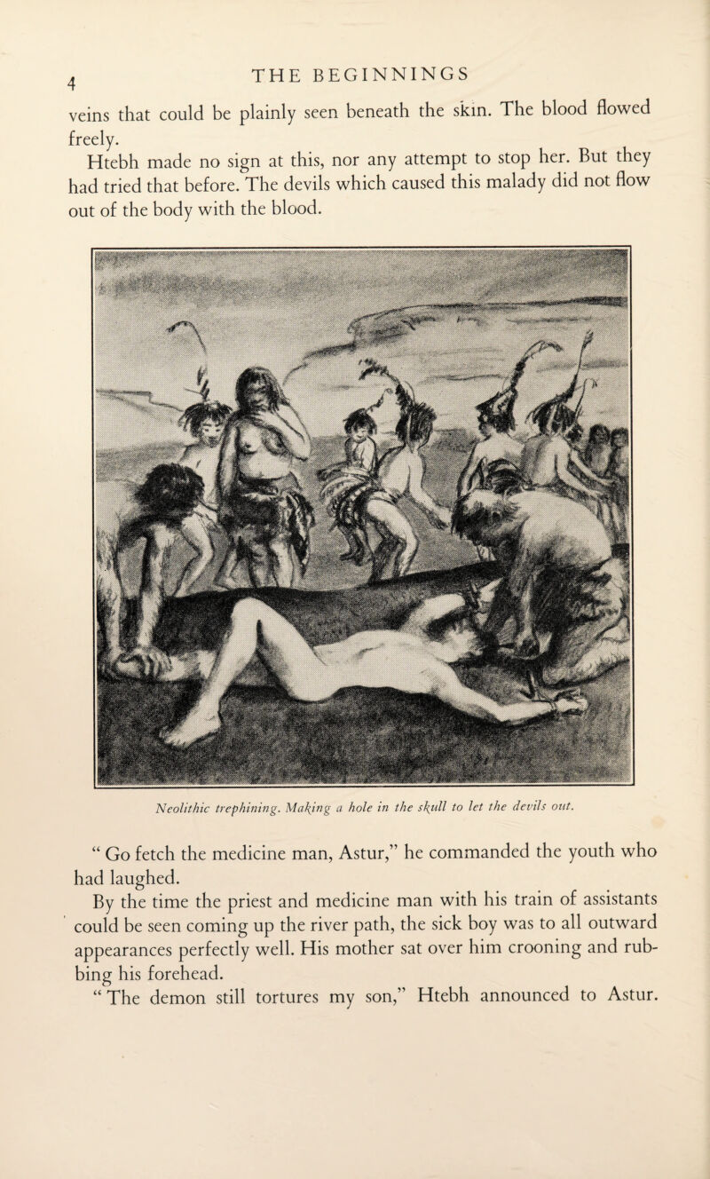 veins that could be plainly seen beneath the skin. The blood flowed freely. Htebh made no sign at this, nor any attempt to stop her. But they had tried that before. The devils which caused this malady did not flow out of the body with the blood. Neolithic trephining. Maying a hole in the skull to let the devils out. “ Go fetch the medicine man, Astur,” he commanded the youth who had laughed. By the time the priest and medicine man with his train of assistants could be seen coming up the river path, the sick boy was to all outward appearances perfectly well. His mother sat over him crooning and rub¬ bing his forehead. “ The demon still tortures my son,” Htebh announced to Astur.