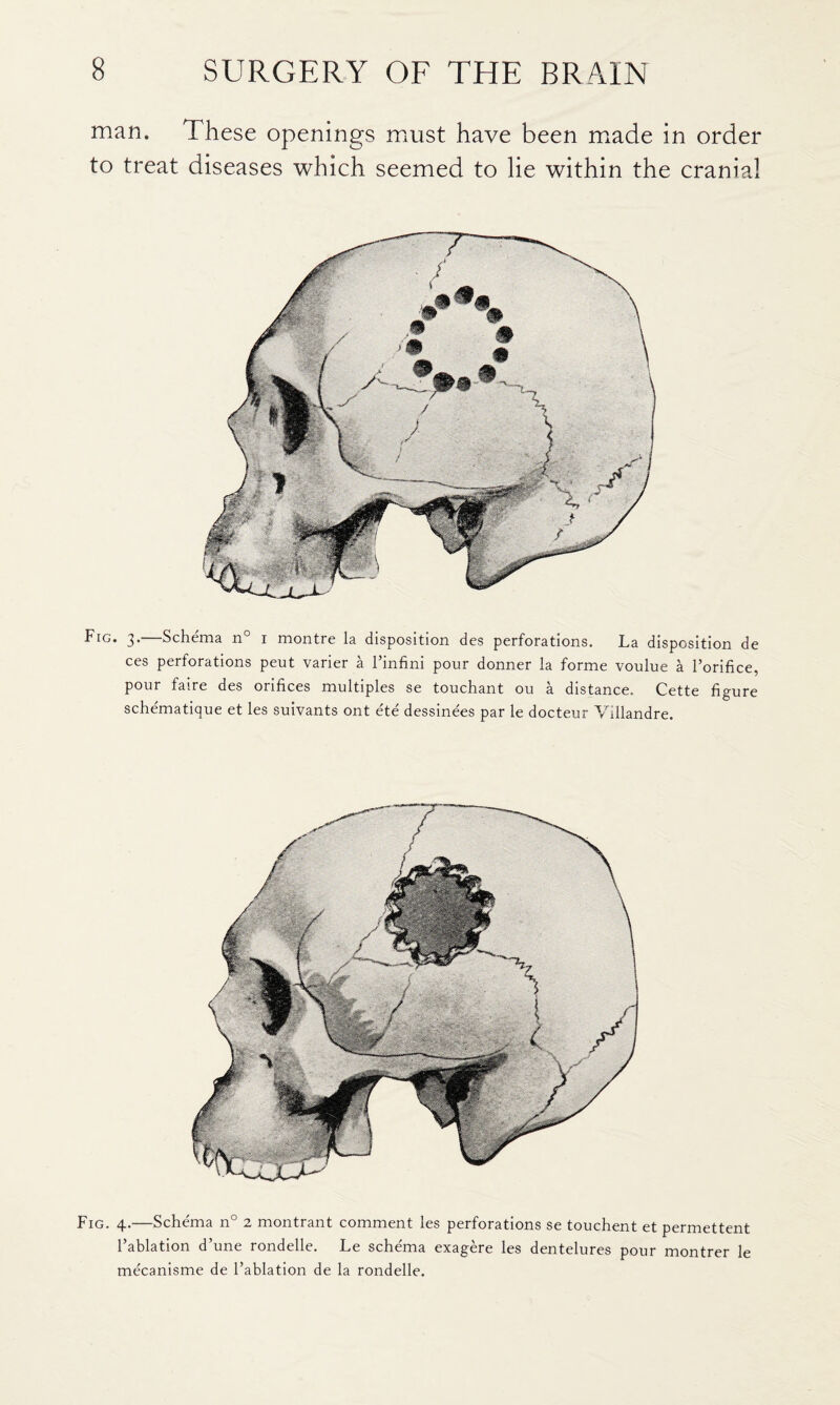 man. These openings miust have been made in order to treat diseases which seemed to lie within the cranial Fig. 3.—Schema n° i montre la disposition des perforations. La disposition de ces perforations pent varier a I’infini pour donner la forme voulue a I’orifice, pour faire des orifices multiples se touchant ou a distance. Cette figure schematique et les suivants ont ete dessinees par le docteur Vhllandre. Fig. 4.—Schema n° 2 montrant comment les perforations se touchent et permettent I’ablation d’une rondelle. Le schema exagere les dentelures pour montrer le mecanisme de I’ablation de la rondelle.