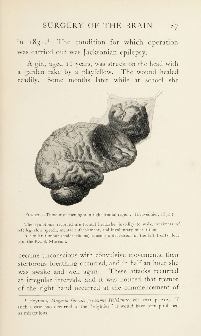 in 183 iB The condition for which operation was carried out was Jacksonian epilepsy. A girl, aged 11 years, was struck on the head with a garden rake by a playfellow. The wound healed readily. Some months later while at school she Fig. 27.—Tumour of meninges in right frontal region. (Cruveilhier, 1830.) The symptoms recorded are frontal headache, inability to walk, weakness of left leg, slow speech, mental enfeeblement, and involuntary micturition. A similar tumour (endothelioma) causing a depression in the left frontal lobe is in the R.C.S. Museum. became unconscious with convulsive movements, then stertorous breathing occurred, and in half an hour she was awake and well again. These attacks recurred at irregular intervals, and it was noticed that tremor of the right hand occurred at the commencement of ^ Heyman, Magasin fur die gesammte Heilkunde, vol. xxxi. p. 212. If such a case had occurred in the eighties it would have been published as miraculous.