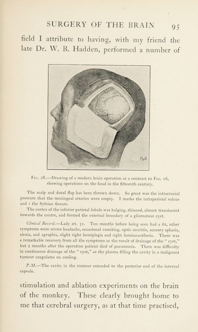 95 field I attribute to having, witli niy friend the late Ur. W. B. Hadden, performed a number of Fig. 28.—Drawing of a modern brain operation as a contrast to Fig. 16, showing operations on the head in the fifteenth century. The scalp and dural flap has been thrown down. So great was the intracranial pressure that the meningeal arteries were empty. I marks the intraparietal sulcus and j the Sylvian fissure. The cortex of the inferior parietal lobule was bulging, thinned, almost translucent towards the centre, and formed the external boundary of a gliomatous cyst. Clinical Record.—Lady aet. ji. Ten months before being seen had a fit, other symptoms were severe headache, occasional vomiting, optic neuritis, sensory aphasia, alexia, and agraphia, slight right hemiplegia and right hemianesthesia. There was a remarkable recovery from all the symptoms as the result of drainage of the “ cyst,” but 2 months after the operation patient died of pneumonia. There was difficulty in continuous drainage of the “ cyst,” as the plasma filling the cavity in a malignant tumour coagulates on cooling. P.M.—The cavity in the tumour extended to the posterior end of the internal capsule. Stimulation and ablation experiments on the brain of the monkey. These clearly brought home to me that cerebral surgery, as at that time practised,