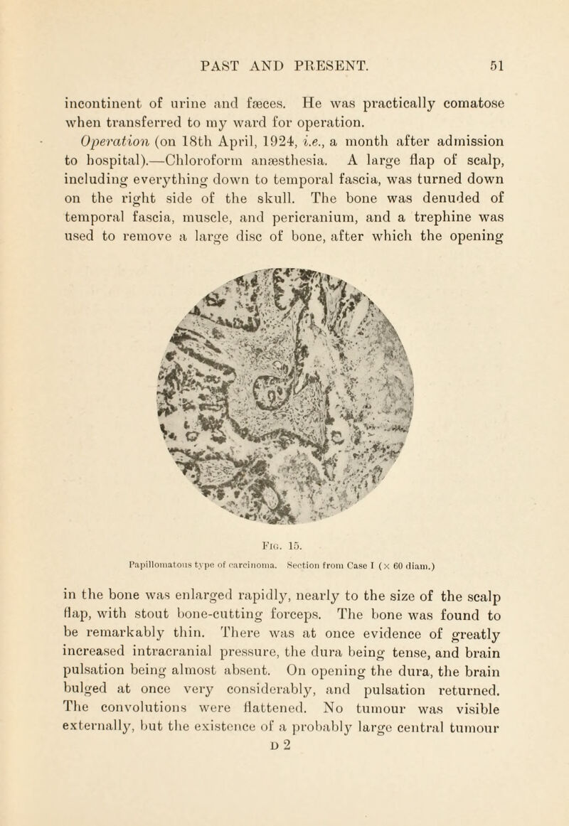 incontinent of urine and feces. He was practically comatose when transferred to my ward for operation. Operation (on 18th April, 1924, i.e., a month after admission to hospital).—Chloroform anaesthesia. A large flap of scalp, including everything down to temporal fascia, was turned down on the right side of the skull. The bone was denuded of temporal fascia, muscle, and pericranium, and a trephine was used to remove a large disc of bone, after which the opening Fig. 15. Papillomatous type of carcinoma. Section from Case I (x GO tliam.) in the bone was enlarged rapidly, nearly to the size of the scalp Hap, with stout bone-cutting forceps. The bone was found to be remarkably thin. There was at once evidence of greatly increased intracranial pressure, the dura being tense, and brain pulsation being almost absent. On opening the dura, the brain bulged at once very considerably, and pulsation returned. The convolutions were flattened. No tumour was visible externally, but the existence ol a probably large central tumour