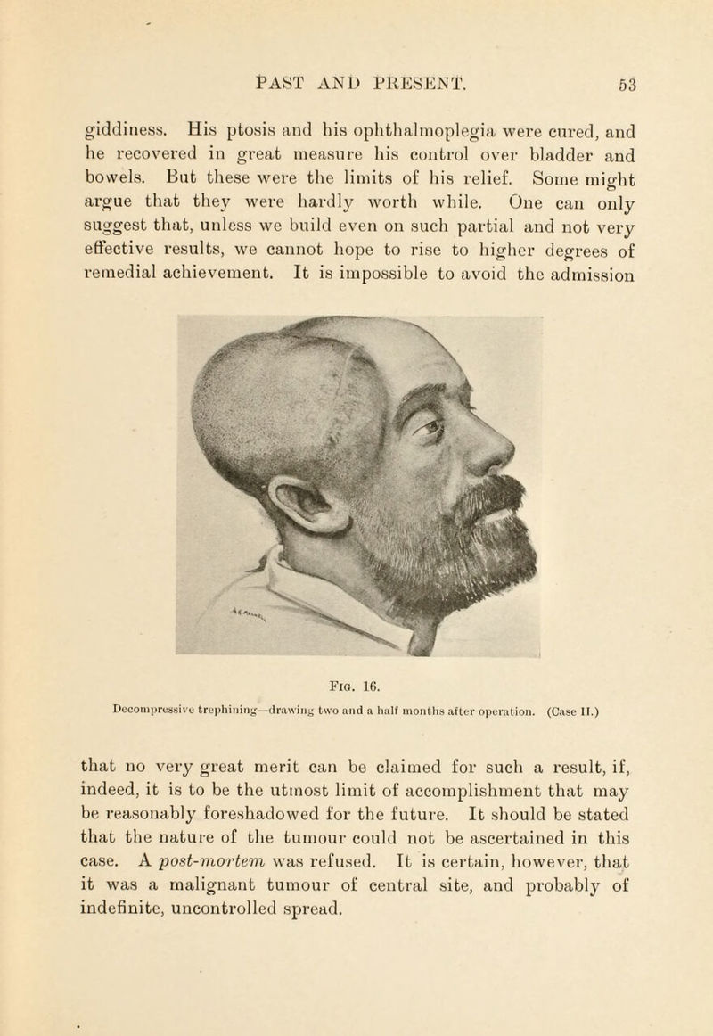 giddiness. His ptosis and his ophthalmoplegia were cured, and he recovered in great measure his control over bladder and bowels. But these were the limits of his relief. Some might o argue that they were hardly worth while. One can only suggest that, unless we build even on such partial and not very effective results, we cannot hope to rise to higher degrees of remedial achievement. It is impossible to avoid the admission Fig. 16. Decompressive trephining—drawing two and a half months after operation. (Case If.) that no very great merit can be claimed for such a result, if, indeed, it is to be the utmost limit of accomplishment that may be reasonably foreshadowed for the future. It should be stated that the nature of the tumour could not be ascertained in this case. A post-mortevi was refused. It is certain, however, that it was a malignant tumour of central site, and probably of indefinite, uncontrolled spread.