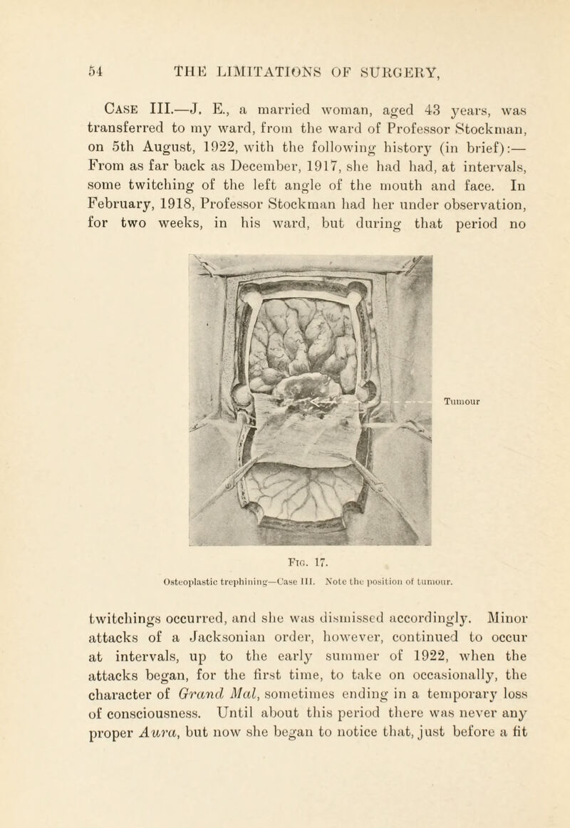 Case III.—J, E., a married woman, aged 43 years, was transferred to my ward, from the ward of Professor Stockman, on 5th August, 1922, with the following history (in brief):— From as far back as December, 1917, she had had, at intervals, some twitching of the left angle of the mouth and face. In February, 1918, Professor Stockman had her under observation, for two weeks, in his ward, but during that period no Tumour Fig. 17. Osteoplastic trephining—Case III. Note the position of tumour. twitchings occurred, and she was dismissed accordingly. Minor attacks of a Jacksonian order, however, continued to occur at intervals, up to the early summer of 1922, when the attacks began, for the first time, to take on occasionally, the character of Grand Mai, sometimes ending in a temporary loss of consciousness. Until about this period there was never any proper Aura, but now she began to notice that, just before a fit