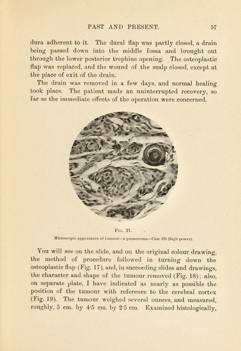 dura adherent to it. The dural flap was partly closed, a drain being passed down into the middle fossa and brought out through the lower posterior trephine opening. The osteoplastic flap was replaced, and the wound of the scalp closed, except at the place of exit of the drain. The drain was removed in a few days, and normal healing took place. The patient made an uninterrupted recovery, so far as the immediate effects of the operation were concerned. Fig. 21. Microscopic appearance of tumour—a psammoma—Case III (hiyh power). You will see on the slide, and on the original colour drawing, the method of procedure followed in turning down the osteoplastic flap (Fig. 17), and, in succeeding slides and drawings, the character and shape of the tumour removed (Fig. 18); also, on separate plate, I have indicated as nearly as possible the position of the tumour with reference to the cerebral cortex (big. 19). The tumour weighed several ounces, and measured, roughly, 5 cm. by 4’5 cm. by 2 5 cm. Examined histologically,