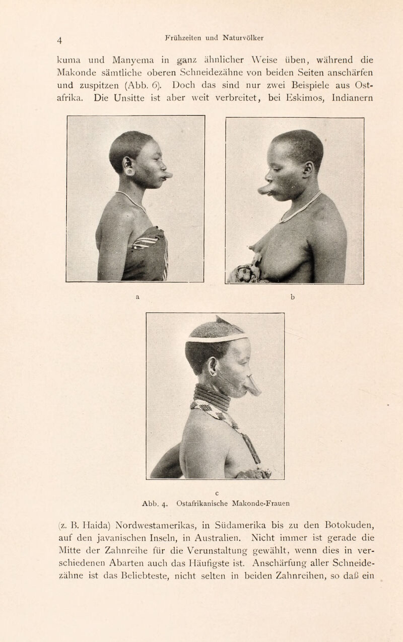 kuma und Manyema in ganz ähnlicher Weise üben, während die Makonde sämtliche oberen Schneidezähne von beiden Seiten anschärfen und zuspitzen (Abb. 6). Doch das sind nur zwei Beispiele aus Ost¬ afrika. Die Unsitte ist aber weit verbreitet, bei Eskimos, Indianern c Abb. 4. Ostafrikanische Makonde-Frauen (z. B. Haida) Nordwestamerikas, in Südamerika bis zu den Botokuden, auf den javanischen Inseln, in Australien. Nicht immer ist gerade die Mitte der Zahnreihe für die Verunstaltung gewählt, wenn dies in ver¬ schiedenen Abarten auch das Häufigste ist. Anschärfung aller Schneide¬ zähne ist das Beliebteste, nicht selten in beiden Zahnreihen, so daß ein