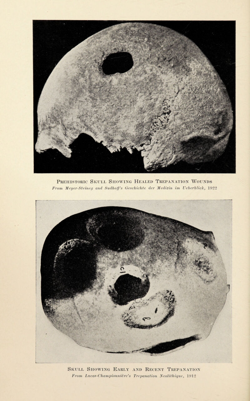 Prehistoric Skull Showing Healed Trepanation Wounds From Meyer-Steineg and Sudhofj’s Geschichte der Medizin im Ueberblick, 1922 Skull Showing Early and Recent Trepanation From Lucas-Champidnniere’s Trepanation Neolithique, 1912