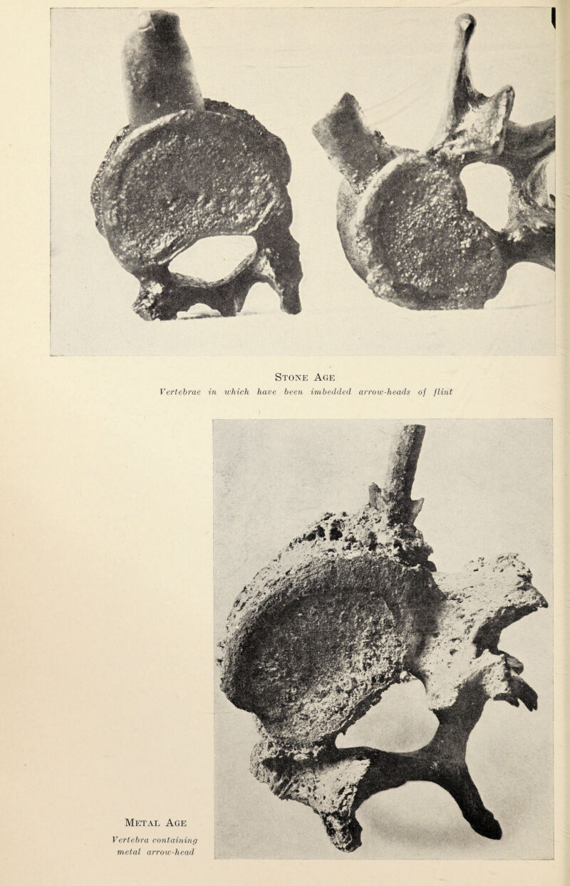 Stone Age Vertebrae in which have been imbedded arrow-heads of flint Metal Age Vertebra containing metal arrow-head