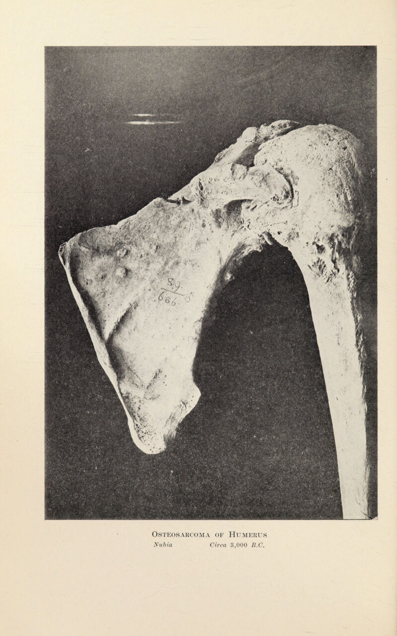 Osteosarcoma of Humerus