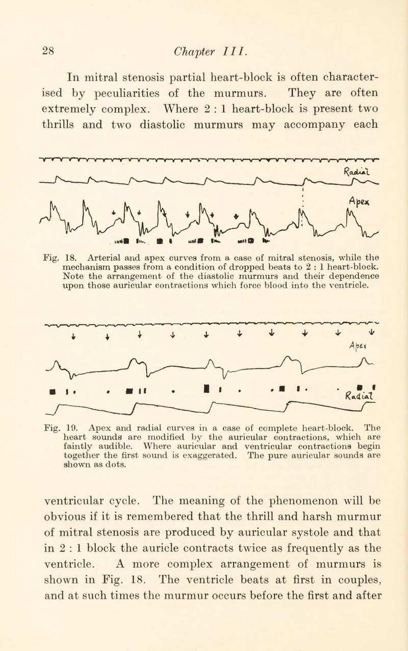 In mitral stenosis partial heart-block is often character¬ ised by peculiarities of the murmurs. They are often extremely complex. Where 2 : 1 heart-block is present two thrills and two diastolic murmurs may accompany each Fig. 18. Arterial and apex curves from a case of mitral stenosis, while the mechanism passes from a condition of dropped beats to 2 : 1 heart-block. Note the arrangement of the diastolic murmurs and their dependence upon those auricular contractions which force blood into the ventricle. Fig. 19. Apex and radial curves in a case of complete heart-block. The heart sounds are modified by the auricular contractions, which are faintly audible. Where auricular and ventricular contractions begin together the first sound is exaggerated. The pure auricular sounds are shown as dots. ventricular cycle. The meaning of the phenomenon will be obvious if it is remembered that the thrill and harsh murmur of mitral stenosis are produced by auricular systole and that in 2 : 1 block the auricle contracts twice as frequently as the ventricle. A more complex arrangement of murmurs is shown in Fig. 18. The ventricle beats at first in couples, and at such times the murmur occurs before the first and after