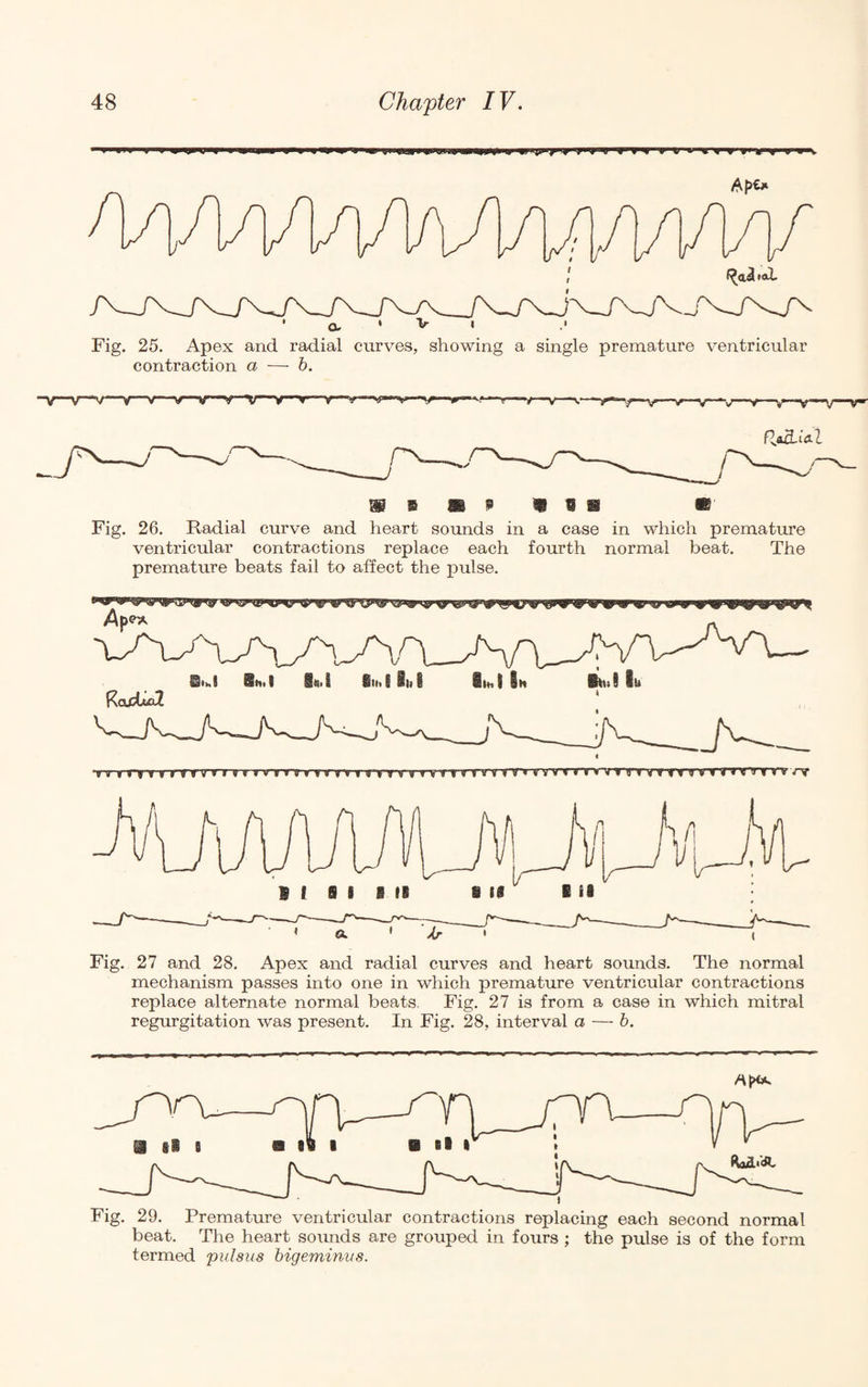 1 *aL f Fig. 25. Apex and radial curves, showing a single premature ventricular contraction a — h. •V 'V~‘v—v -V V ir ■v fdad-i<a-l Fig. 26. Radial curve and heart soimds in a case in which premature ventricular contractions replace each fourth normal beat. The premature beats fail to alfect the pulse. Fig. 27 and 28. Apex and radial curves and heart sounds. The normal mechanism passes into one in which premature ventricular contractions replace alternate normal beats, Fig. 27 is from a case in which mitral regurgitation was present. In Fig. 28, interval a — h. Fig. 29. Premature ventricular contractions replacing each second normal beat. The heart sounds are grouped in fours ; the pulse is of the form termed pulsus bigeminus.