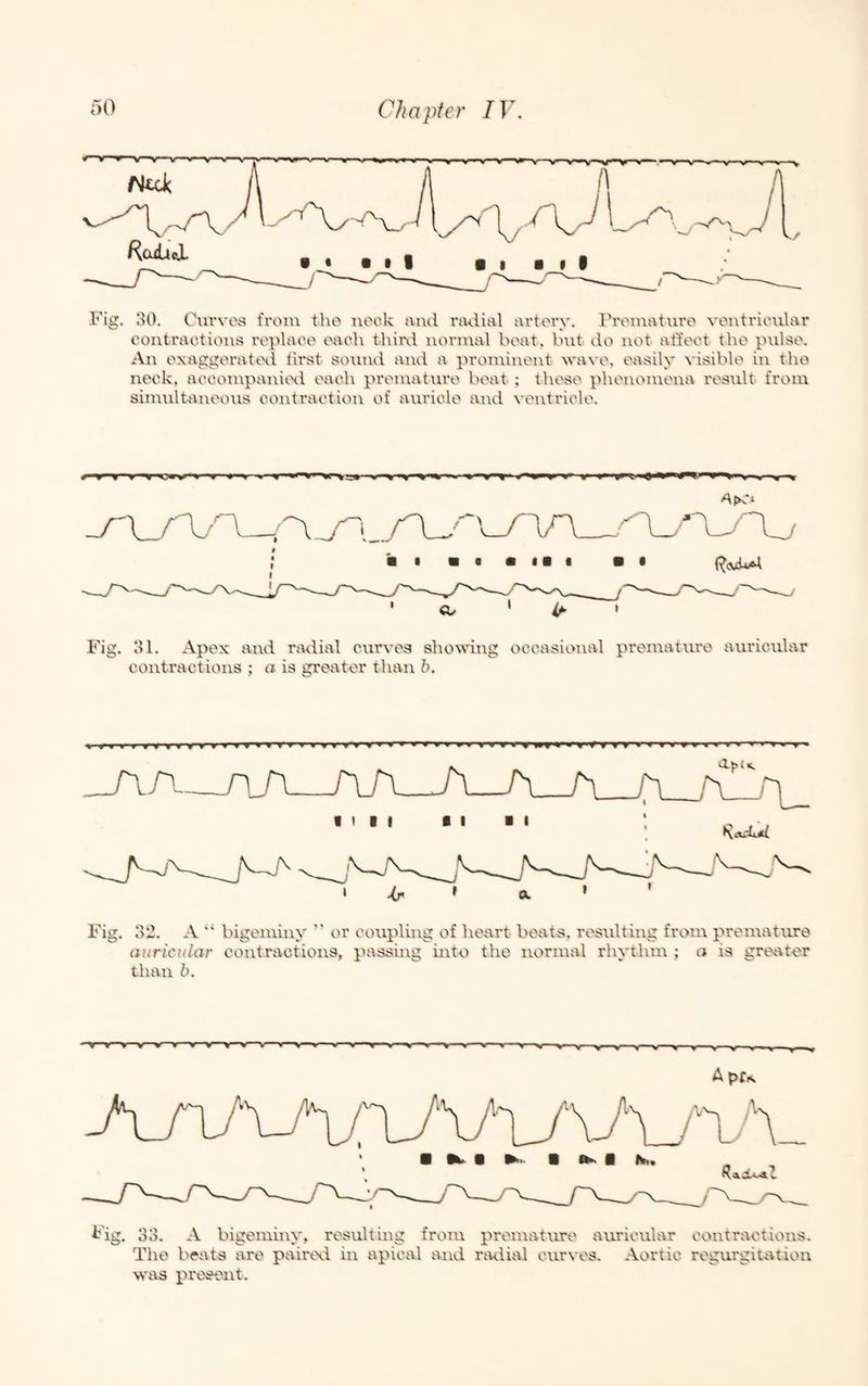 Fiil. l>0, Ourvos from the nock and radial artery, rromatnro ventricular contractions replace each thiixl normal heat, but do not alTect the pulse. An exaggerated first sound and a pron\inent wave, easily visible in the neck, accompatiitxl each preniature beat ; these phenomena result from simultaneous contraction of auricle and ventricle. ^fK £ Fig, 31, Apex and radial curves sho^ving occasional premature auricular contractions ; a is greater than h. » » > f r7r~^nr> v » i r'» r~r » » » » » < y r » » » k » **■» ryr «■»■»>»«» » » t a I M * mm mm * Fig. 32. A “ bigei\iiny ” or coupling of heart beats, resulting from premature auricular contractions, passhig into the normal rhythm ; a is greater than b. -V—V—V—V-V—V ^'-v-V ----■» -V --- ----V V '»-»---« V-V y-----y-^ ApfK Fig. 33. A bigemiiu', resulting from premature auricular contractions. The beats are paiiwi in apical and radial curves. Aortic regurgitation was present.