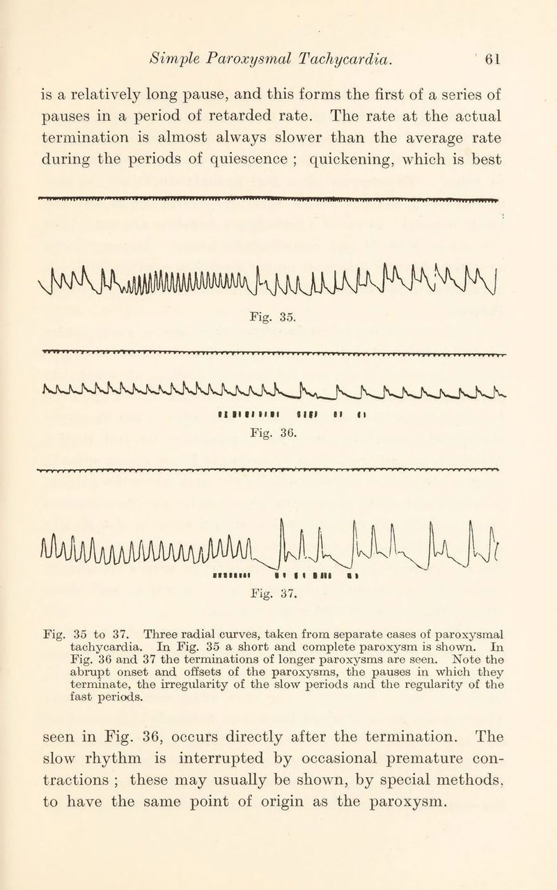 is a relatively long pause, and this forms the first of a series of pauses in a period of retarded rate. The rate at the actual termination is almost always slower than the average rate during the periods of quiescence ; quickening, which is best 11 IP mi III II i»Wff <■»»»■■» nniiiwiiiiim>iiiiiiiimm»HHiiinniiiiiiiw»ffnHmlWTTr KiiTmMKiiiiiKiiiivmrTrnvvvmr till I • '^1' Ilf 111‘nt tn tTii frr-rfrinttittttttttttiiffftififiitif fff f , , » f 11 II IIII n 11 nil II ti Fig. 36. rt ^ V ¥ iWiWamMAAam/iMAM- \p • I I I I 111 11 Fig. 37. Fig. 35 to 37. Three radial curves, taken from separate cases of paroxysmal tachycardia. In Fig. 35 a short and complete paroxysm is shown. In Fig. 36 and 37 the terminations of longer paroxysms are seen. Note the abrupt onset and offsets of the paroxysms, the pauses in which they terminate, the irregiilarity of the slow periods and the regularity of the fast periods. seen in Fig. 36, occurs directly after the termination. The slow rhythm is interrupted by occasional premature con¬ tractions ; these may usually be shown, by special methods, to have the same point of origin as the paroxysm.