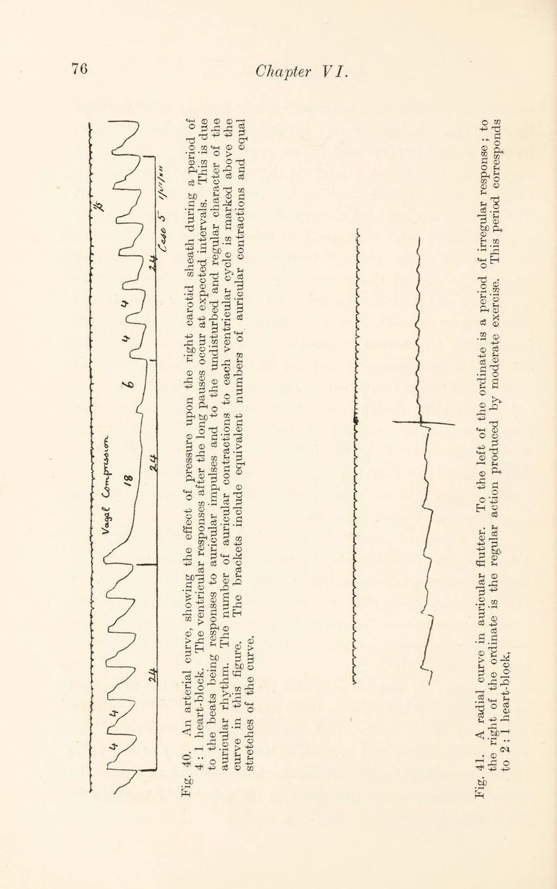 O ® .rH c6 ^ ® <D rC 'Ti CO '+H •ri o to fcJD fl • ^ u O rSH -P CO > o rO cS TJ CO vu ■+^ ce 2 CO -p O P o •+3 .^§ -P o ® Ph X -p c3 p P p o3 'B &D (D P P & Tj <D rP , P P -P to • f—< ri CD Pi -P P O P a © o o p p 3 o • p -p p ID > rP D p D O -P P P CP D T5 P P to P o • ^ p> o p p -p p o D P P 9 o • fH p P P p-i o to p D P5 P P P o D Pi p) p D -P p-i P to D to P O Pc CO D P P 9 9 o pT • rH ^ -P O ^ to D P P to CO D p Pc -P o D SK D D -P -P tJ3 P t3 P P CO D to 9 Ph P ,9 o ’ p p p p o • fH •PH O P P -P P o o p pp 9 o • ^ p p p p D —H P > P CP D D Ti P —t o p p D > D -P H o ^ ^ D rP to p D to P O Ph D to P D P H bD P P to -p D Pi o p p rP p 2 P ^ P H 9^ D h P ^ bC c Pi , p D -p p p o bb pa to •p p D rP D Pi +3 -p rP -P P _P rP CO p p 9 o • fH p P P Fig. 41. A radial curve in auricular flutter. To the left of the ordinate is a period of irregular response ; to the right of the ordinate is the regular action produced by moderate exercise. This period corresponds to 2:1 heart-block, ^