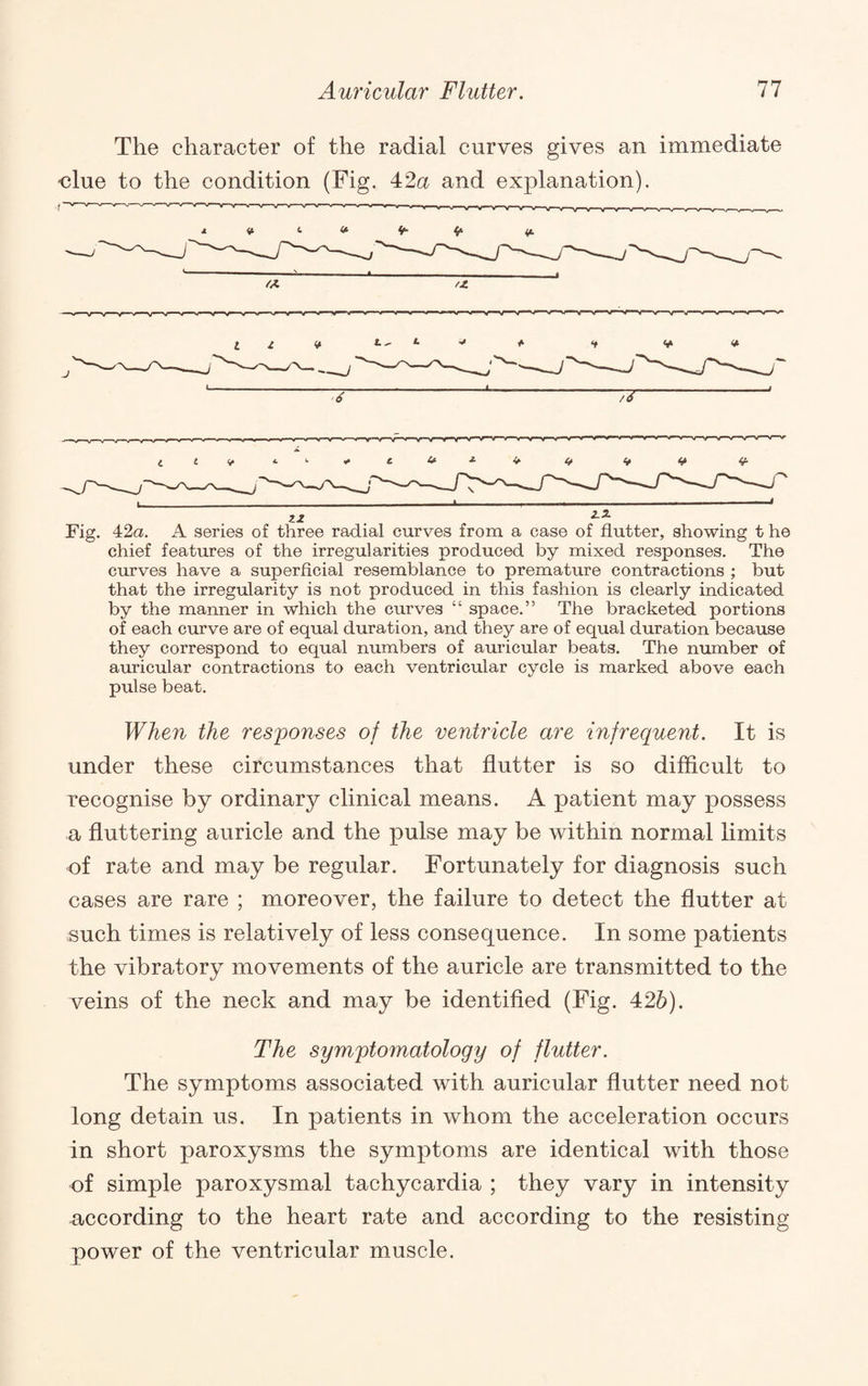 The character of the radial curves gives an immediate -clue to the condition (Fig. 42a and explanation). t If tf- If — ^ * rA /Z ■NT I z ^ ^ gt /6 j Fig. 42a. A series of three radial curves from a case of flutter, showing t he chief features of the irregularities produced by mixed responses. The curves have a superficial resemblance to premature contractions ; but that the irregularity is not produced in this fashion is clearly indicated by the manner in which the curves “ space.” The bracketed portions of each curve are of equal duration, and they are of equal duration because they correspond to equal numbers of auricular beats. The number of auricular contractions to each ventricular cycle is marked above each pulse beat. When the responses of the ventricle are infrequent. It is under these circumstances that flutter is so difflcult to recognise by ordinary clinical means. A patient may possess a fluttering auricle and the pulse may be within normal limits of rate and may be regular. Fortunately for diagnosis such cases are rare ; moreover, the failure to detect the flutter at such times is relatively of less consequence. In some patients the vibratory movements of the auricle are transmitted to the veins of the neck and may be identified (Fig. 42&). The symptomatology of flutter. The symptoms associated with auricular flutter need not long detain us. In patients in whom the acceleration occurs in short paroxysms the symptoms are identical with those of simple paroxysmal tachycardia ; they vary in intensity according to the heart rate and according to the resisting power of the ventricular muscle.