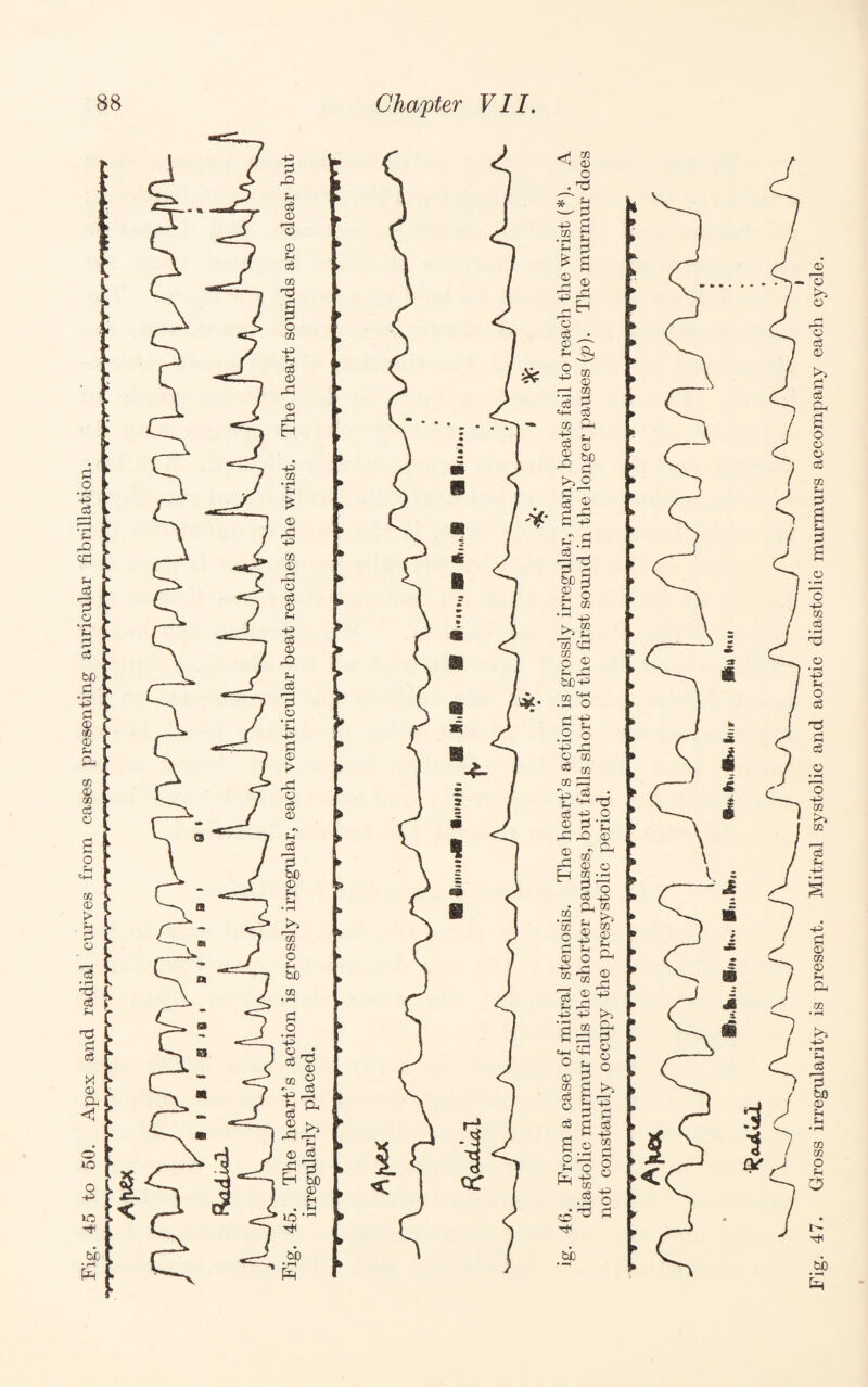 Fig. 47. Gross irregularity is present. Mitral systolic and aortic diastolic murmurs accompany each cycle.
