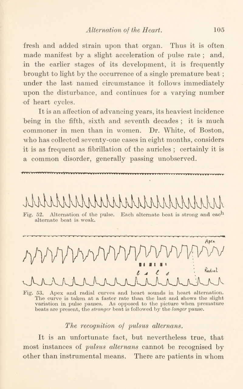 fresh and added strain upon that organ. Thus it is often made manifest by a slight acceleration of pulse rate ; and, in the earlier stages of its development, it is frequently brought to light by the occurrence of a single premature beat ; under the last named circumstance it follows immediately upon the disturbance, and continues for a varying number of heart cycles. It is an affection of advancing years, its heaviest incidence being in the fifth, sixth and seventh decades ; it is much commoner in men than in women. Dr. White, of Boston, who has collected seventy-one cases in eight months, considers it is as frequent as fibrillation of the auricles ; certainly it is a common disorder, generally passing unobserved. Fig. 52. Alternation of the pulse, alternate beat is weak. Each alternate beat is strong and eac h Fig. 53. Apex and radial curves and heart sounds in heart alternation. The curve is taken at a faster rate than the last and shows the slight variation in pulse pauses. As opposed to the picture when premature beats are present, the stronger beat is followed by the longer pause. The recognition of pulsus alter nans. It is an unfortunate fact, but nevertheless true, that most instances of pulsus alternans cannot be recognised by other than instrumental means. There are patients in whom