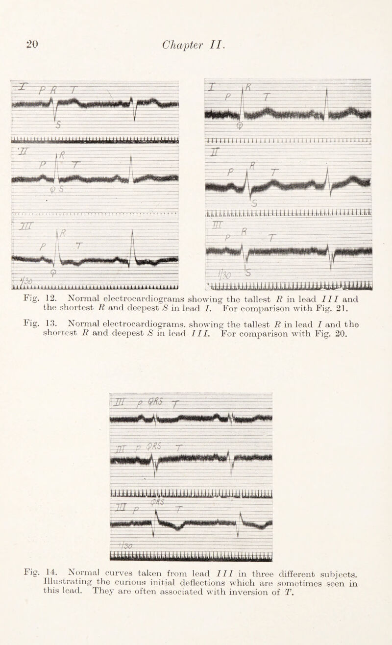 ^ ’ »■ Mhu^ yxfJn.y,1t Fjg. 12. Normal electrocardiograms showing the tallest R in lead III and the shortest R and deepest S in lead I. For comparison with Fig. 21. Fig. 13. Normal electrocardiograms, showing the tallest R in lead I and the shortest R and deepest S in lead III. For comparison with Fig. 20. E§2 Fig. 14. Normal curves taken from lead III in three different subjects. Illustrating the curious initial deflections which are sometimes seen in this lead. They are often associated with inversion of T.