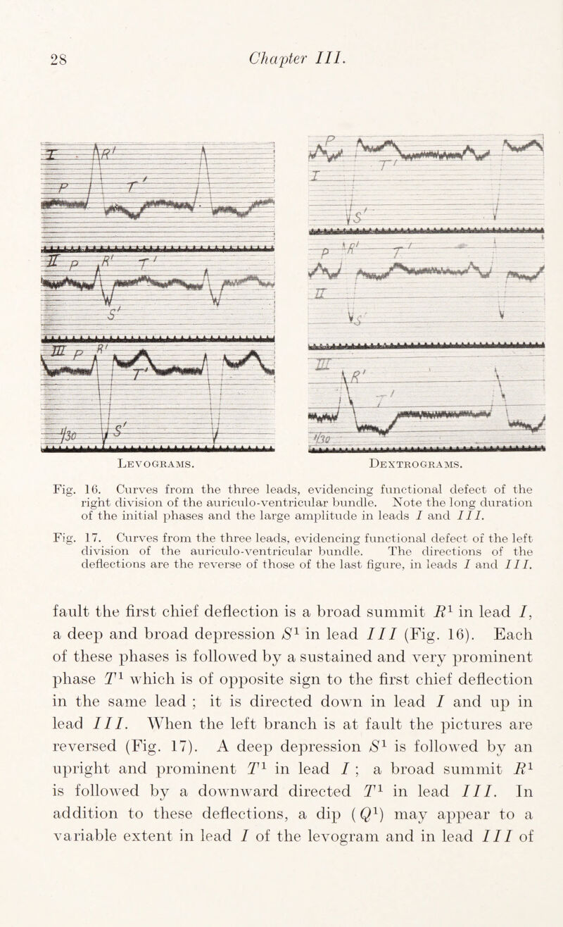 Le VO GRAMS. Dextrogbams. Fig. 16. Curves from the three leads, evidencing functional defect of the right division of the auriculo-ventricular bundle. Note the long duration of the initial phases and the large amplitude in leads I and III. Fig. 17. Curves from the three leads, evidencing functional defect of the left division of the auriculo-ventricular bundle. The directions of the deflections are the reverse of those of the last figure, in leads I and III. fault the first chief deflection is a broad summit R1 in lead I, a deep and broad depression S1 in lead III (Fig. 16). Each of these phases is followed by a sustained and very prominent phase T1 which is of opposite sign to the first chief deflection in the same lead ; it is directed down in lead / and up in lead III. When the left branch is at fault the pictures are reversed (Fig. 17). A deep depression S1 is followed by an upright and prominent T1 in lead I ; a broad summit R1 is followed by a downward directed T1 in lead III. In addition to these deflections, a dip (Q1) may appear to a variable extent in lead I of the levogram and in lead III of