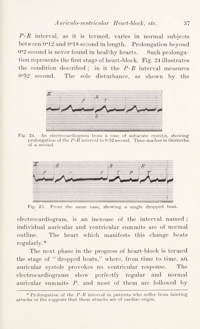 P-B interval, as it is termed, varies in normal subjects between 0*12 and 0*18 second in length. Prolongation beyond 0*2 second is never found in healthy hearts. Such prolonga¬ tion represents the first stage of heart-block. Fig. 24 illustrates the condition described ; in it the P-B interval measures 0*32 second. The sole disturbance, as shown bv the - .r ■ • > .... . ... . .v .' . . ' ■ a . -■->»--—.....— --—- ■■ - - .:. “ •  ... . - ■- A : .-.- - . .- . - -.-.. .- - . •.- ... ,~. ..■ Vi uTiUTtiTiii i uTii riTmTmTTi 'iiii Fig. 24. An electrocardiogram from a case of subacute cystitis, showing- prolongation of the P-R interval to 0-32 second. Time-marker in thirtieths of a second. electrocardiogram, is an increase of the interval named ; individual auricular and ventricular summits are of normal outline. The heart which manifests this change beats regularly.* The next phase in the progress of heart-block is termed the stage of cc dropped beats,” where, from time to time, an. auricular systole provokes no ventricular response. The electrocardiograms show perfectly regular and normal auricular summits P, and most of them are followed by * Prolongation of the P-R interval in patients who suffer from fainting attacks or fits suggests that these attacks are of cardiac origin.