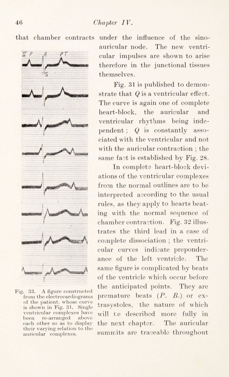 that chamber contracts Fig. 33. A figure constructed from the electrocardiograms of the patient, whose curve is shown in Fig. 31. Single ventricular complexes have been re-arranged above each other so as to display their varying relation to the auricular complexes. under the influence of the sino- auricular node. The new ventri¬ cular impulses are shown to arise therefore in the junctional tissues themselves. Fig. 31 is published to demon¬ strate that Q is a ventricular effect. The curve is again one of complete heart-block, the auricular and ventricular rhythms being inde¬ pendent ; Q is constantly asso¬ ciated with the ventricular and not with the auricular contraction ; the same fact is established by Fig. 28. In complete heart-block devi¬ ations of the ventricular complexes from the normal outlines are to be interpreted according to the usual rules, as they apply to hearts beat¬ ing with the normal sequence of chamber contraction. Fig. 32 illus¬ trates the third lead in a case of complete dissociation ; the ventri¬ cular curves indicate preponder¬ ance of the left ventricle. The same figure is complicated by beats of the ventricle which occur before the anticipated points. They are premature beats (P. B.) or ex¬ trasystoles, the nature of which will te described more fully in the next chapter. The auricular summits are traceable throughout