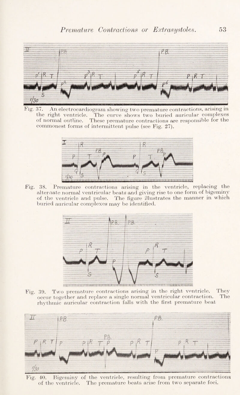 Fig. 37. An electrocardiogram showing two premature contractions, arising in the right ventricle. The curve shows two buried auricular complexes of normal outline. These premature contractions are responsible for the commonest forms of intermittent pulse (see Fig. 27). Fig. 38. Premature contractions arising in the ventricle, replacing the alternate normal ventricular beats and giving rise to one form of bigeminv of the ventricle and pulse. The figure illustrates the manner in which buried auricular complexes may be identified. Fig. 39. Two premature contractions arising in the right ventricle. They occur together and replace a single normal ventricular contraction. The rhythmic auricular contraction falls with the first premature beat Fig. 40. Bigeminy of the ventricle, resulting from premature contractions of the ventricle. The premature beats arise from two separate foci.