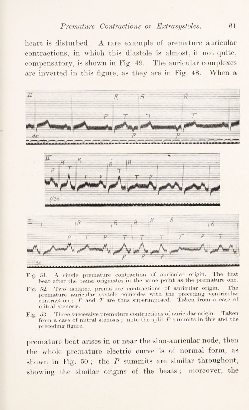 heart is disturbed. A rare example of premature auricular contractions, in which this diastole is almost, if not quite, compensatory, is shown in Fig. 49. The auricular complexes are inverted in this figure, as they are in Fig. 48. When a Fig. 51. A single premature contraction of auricular origin. The first beat after the pause originates in the same point as the premature one. Fig. 52. Two isolated premature contractions of auricular origin. The premature auricular systole coincides with the preceding ventricular contraction ; P and T are thus superimposed. Taken from a case of mitral stenosis. Fig. 53. Three successive premature contractions of auricular origin. Taken from a case of mitral stenosis ; note the split P summits in this and the preceding figure. premature beat arises in or near the sino-auricular node, then the whole premature electric curve is of normal form, as shown in Fig. 50 ; the P summits are similar throughout, showing the similar origins of the beats ; moreover, the