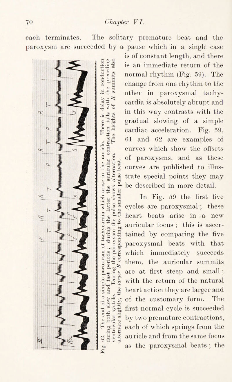d be o os® H^G c3 J o ® d5 © 15 O — 5 o G © G H rH M r-P •rH c$ r ft? '+H £ o ® CO CS rG © «+h bi © _, ’© r* G c* EH O ^ © © XI . ce EH © Sh “ rG -P o d 'C o d o d each terminates. The solitary premature beat and the paroxysm are succeeded by a pause which in a single case is of constant length, and there is an immediate return of the normal rhythm (Fig. 59). The change from one rhythm to the other in paroxysmal tachy¬ cardia is absolutely abrupt and in this way contrasts with the gradual slowing of a simple cardiac acceleration. Fig. 59, 61 and 62 are examples of curves which show the offsets of paroxysms, and as these curves are published to illus¬ trate special points they may be described in more detail. In Fig. 59 the first five cycles are paroxysmal ; these heart beats arise in a new auricular focus ; this is ascer¬ tained by comparing the five paroxysmal beats with that which immediately succeeds them, the auricular summits are at first steep and small ; with the return of the natural heart action they are larger and £^3 £ of the customary form. The © £ ce X r-i « © A ^ ■ £> © . d X ® © oS cS 15 ® Cl, *2 X ^ © G +3 o © rG rG ^ o p m 3 • G © d rG © G £ 15 ® « © cs 3 x rd © rG © 0 CS ^ rG 4= © [>„ bJD . bJD X G G G TS 1/3 'w O cl O - * ST cs co q_ o S? o © o fr-gg ° O © (V 0,44- G fc. ^ * fH g. © G d E5 d Q e Pm r—i C 0^2. d5 * I'-^g first normal cvcle is succeeded G.G ®.2P ® o § - d^ by two premature contractions, h w>.| g each of which springs from the auricle and from the same focus as the paroxysmal beats ; the CM 441 P G © © 15 > oS