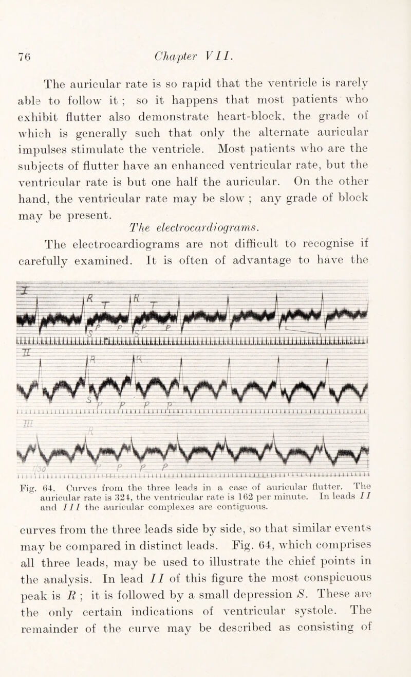 The auricular rate is so rapid that the ventricle is rarely able to follow it ; so it happens that most patients who exhibit flutter also demonstrate heart-block, the grade of which is generally such that only the alternate auricular impulses stimulate the ventricle. Most patients who are the subjects of flutter have an enhanced ventricular rate, but the ventricular rate is but one half the auricular. On the other hand, the ventricular rate may be slow ; any grade of block may be present. The electrocardiograms. The electrocardiograms are not difficult to recognise if carefully examined. It is often of advantage to have the Fig. 64. Curves from the three leads in a case of auricular flutter. The auricular rate is 324, the ventricular rate is 162 per minute. In leads II and III the auricular complexes are contiguous. curves from the three leads side by side, so that similar events may be compared in distinct leads. Fig. 64, which comprises all three leads, may be used to illustrate the chief points in the analysis. In lead //of this figure the most conspicuous peak is B ; it is followed by a small depression S. These are the only certain indications of ventricular systole. The remainder of the curve may be described as consisting of