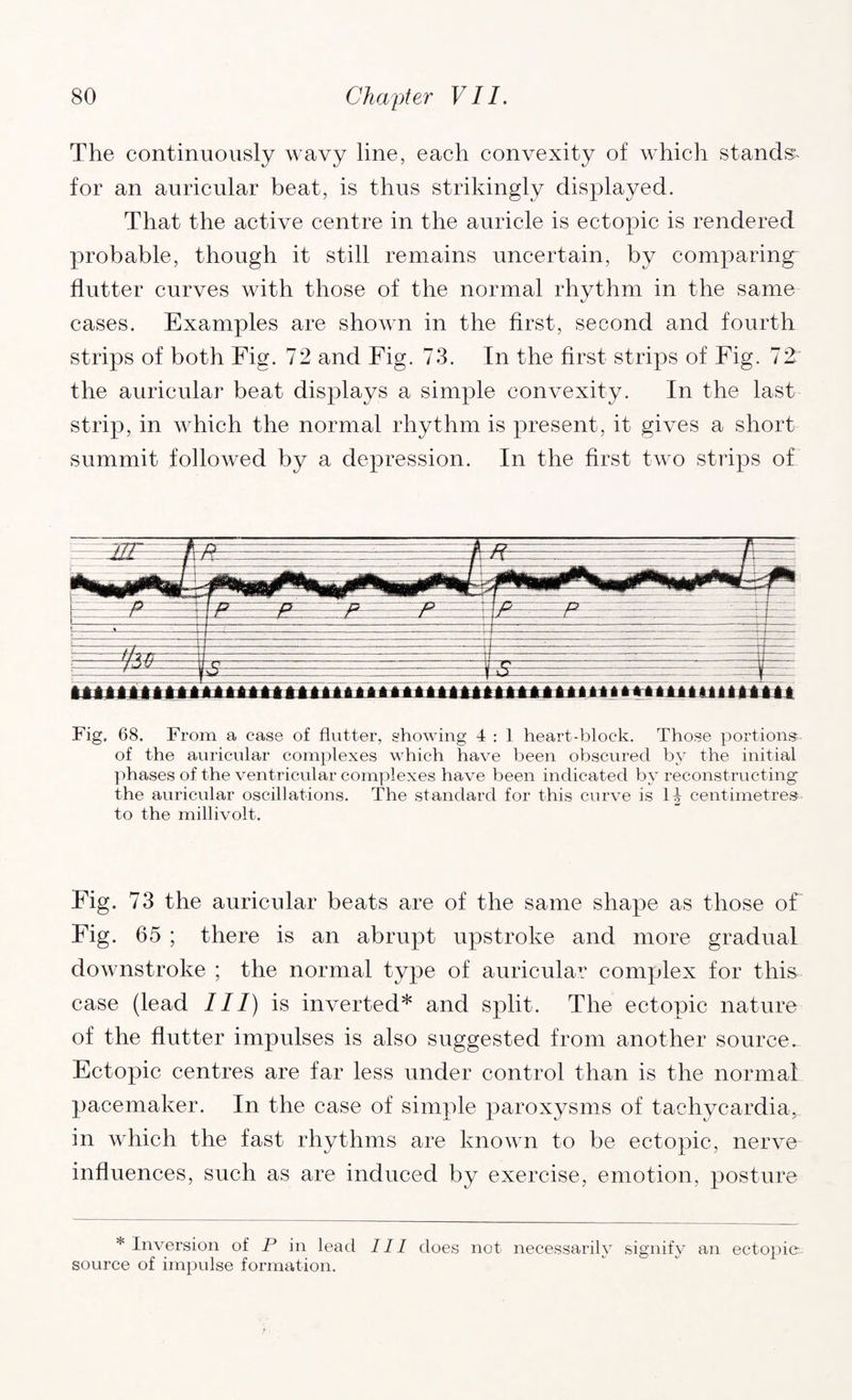 The continuously wavy line, each convexity of which stands- for an auricular beat, is thus strikingly displayed. That the active centre in the auricle is ectopic is rendered probable, though it still remains uncertain, by comparing flutter curves with those of the normal rhythm in the same cases. Examples are shown in the first, second and fourth strips of both Fig. 72 and Fig. 73. In the first strips of Fig. 72 the auricular beat displays a simple convexity. In the last strip, in which the normal rhythm is present, it gives a short summit followed by a depression. In the first two strips of Fig, 68. From a case of flutter, showing 4 : 1 heart-block. Those portions of the auricular complexes which have been obscured by the initial phases of the ventricular complexes have been indicated by reconstructing the auricular oscillations. The standard for this curve is 14 centimetres to the millivolt. Fig. 73 the auricular beats are of the same shape as those of Fig. 65 ; there is an abrupt upstroke and more gradual downstroke ; the normal type of auricular complex for this case (lead III) is inverted* and split. The ectopic nature of the flutter impulses is also suggested from another source.. Ectopic centres are far less under control than is the normal pacemaker. In the case of simple paroxysms of tachycardia, in which the fast rhythms are known to be ectopic, nerve influences, such as are induced by exercise, emotion, posture * Inversion of P in lead III does not necessarily signify an ectopic source of impulse formation.