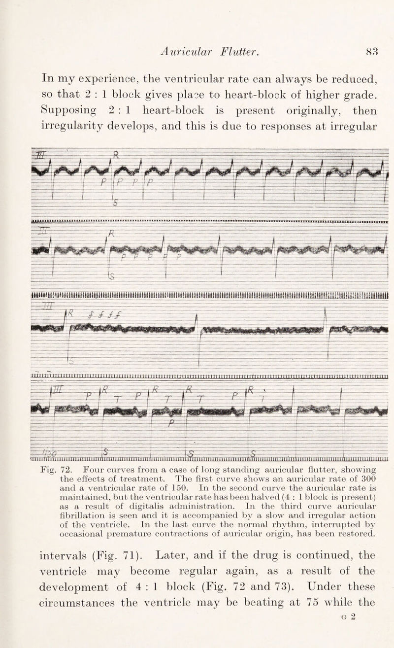 In my experience, the ventricular rate can always be reduced, so that 2 : 1 block gives place to heart-block of higher grade. Supposing 2 : 1 heart-block is present originally, then irregularity develops, and this is due to responses at irregular Fig. 72. Four curves from a case of long standing auricular flutter, showing the effects of treatment. The first curve shows an auricular rate of 300 and a ventricular rate of 150. In the second curve the auricular rate is maintained, but the ventricular rate has been halved (4 : 1 block is present) as a result of digitalis administration. In the third curve auricular fibrillation is seen and it is accompanied by a slow and irregular action of the ventricle. In the last curve the normal rhythm, interrupted by occasional premature contractions of auricular origin, has been restored. intervals (Fig. 71). Later, and if the drug is continued, the ventricle may become regular again, as a result of the development of 4 : 1 block (Fig. 72 and 73). Under these circumstances the ventricle may be beating at 75 while the G 2