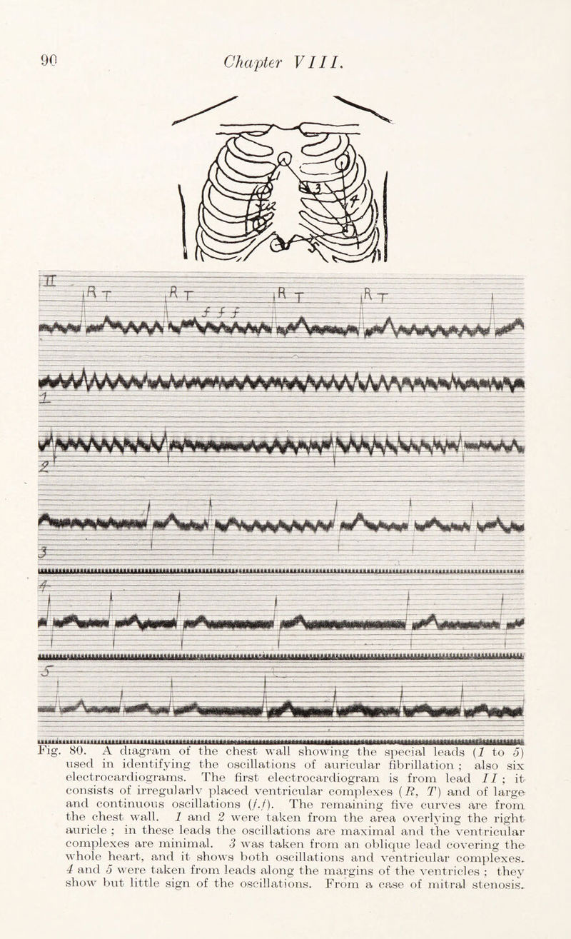 Fig. 80. A diagram of the chest wall showing the special leads (1 to 5) used in identifying the oscillations of auricular fibrillation ; also six electrocardiograms. The first electrocardiogram is from lead II ; it consists of irregularly placed ventricular complexes (E, T) and of large and continuous oscillations (/./). The remaining five curves are from the chest wall. 1 and 2 were taken from the area overlying the right auricle ; in these leads the oscillations are maximal and the ventricular complexes are minimal. 3 was taken from an oblique lead covering the- whole heart, and it shows both oscillations and ventricular complexes. 4 and 5 were taken from leads along the margins of the ventricles ; they show bnt little sign of the oscillations. From a ca,se of mitral stenosis.