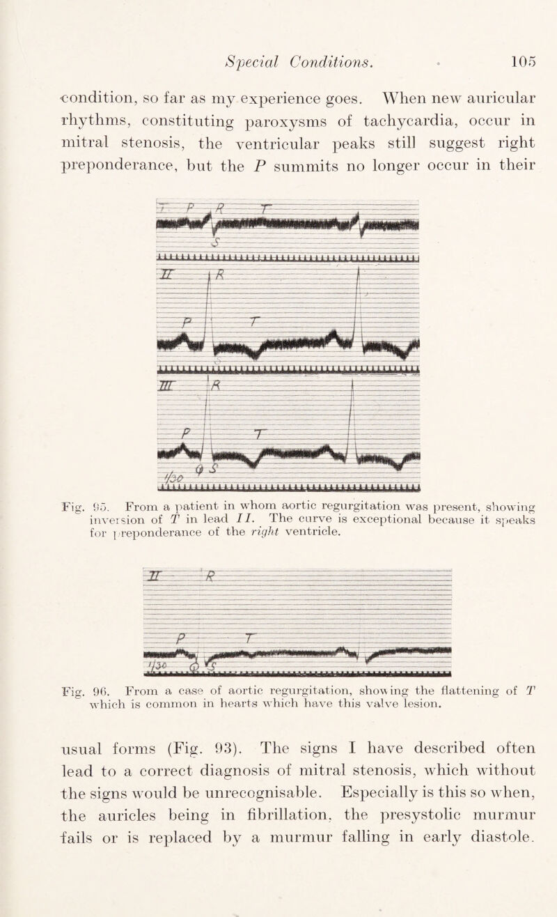 condition, so far as my experience goes. When new auricular rhythms, constituting paroxysms of tachycardia, occur in mitral stenosis, the ventricular peaks still suggest right preponderance, but the P summits no longer occur in their ,-n^i Fig. 95. From a patient in whom aortic regurgitation was present, showing inversion of T in lead II. The curve is exceptional because it speaks for preponderance of the right ventricle. Fig. 96. From a case of aortic regurgitation, showing the flattening of T wdiich is common in hearts wrhich have this valve lesion. usual forms (Fig. 93). The signs I have described often lead to a correct diagnosis of mitral stenosis, which without the signs would be unrecognisable. Especially is this so when, the auricles being in fibrillation, the presystolic murmur tails or is replaced by a murmur falling in early diastole.