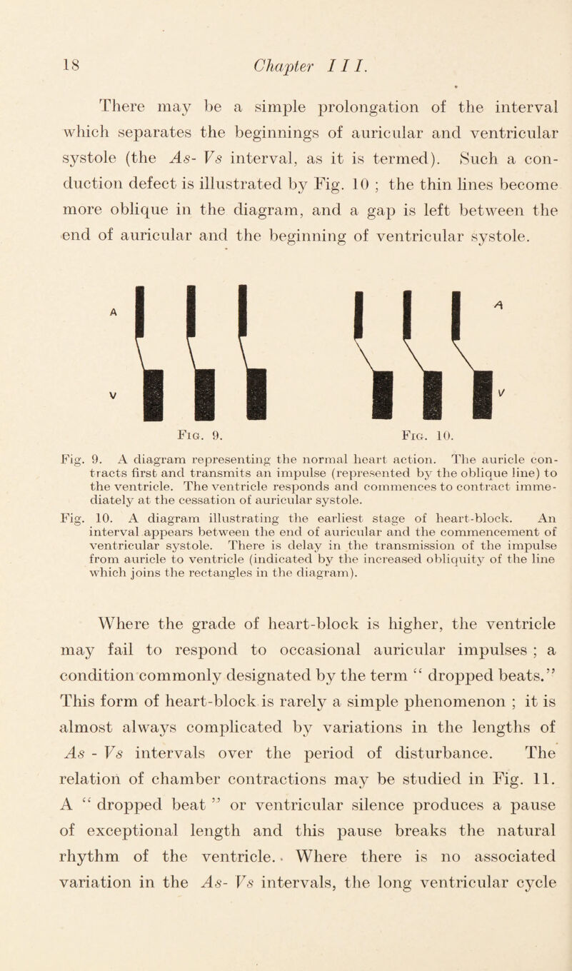 There may be a simple prolongation of the interval which separates the beginnings of auricular and ventricular systole (the As- Vs interval, as it is termed). Such a con¬ duction defect is illustrated by Fig. 10 ; the thin lines become more oblique in the diagram, and a gap is left between the end of auricular and the beginning of ventricular systole. * v Fig. 9. Fig. 10. Fig. 9. A diagram representing the normal heart action. The auricle con¬ tracts first and transmits an impulse (represented by the oblique line) to the ventricle. The ventricle responds and commences to contract imme¬ diately at the cessation of auricular systole. Fig. 10. A diagram illustrating the earliest stage of heart-block. An interval appears between the end of auricular and the commencement of ventricular systole. There is delay in the transmission of the impulse from auricle to ventricle (indicated by the increased obliquity of the line which joins the rectangles in the diagram). Where the grade of heart-block is higher, the ventricle may fail to respond to occasional auricular impulses ; a condition commonly designated by the term “ dropped beats.” This form of heart-block is rarely a simple phenomenon ; it is almost always complicated by variations in the lengths of As - Vs intervals over the period of disturbance. The relation of chamber contractions may be studied in Fig. 11. A “ dropped beat 5 5 or ventricular silence produces a pause of exceptional length and this pause breaks the natural rhythm of the ventricle.. Where there is no associated variation in the As- Vs intervals, the long ventricular cycle
