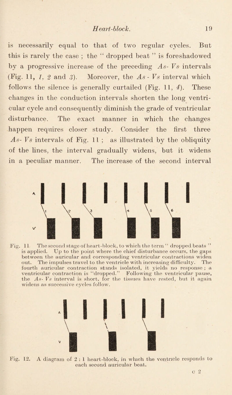 is necessarily equal to that of two regular cycles. But this is rarely the case ; the “ dropped beat ” is foreshadowed by a progressive increase of the preceding As- Vs intervals (Fig. 11, 1, 2 and 3). Moreover, the As - Vs interval which follows the silence is generally curtailed (Fig. 11, 4). These changes in the conduction intervals shorten the long ventri¬ cular cycle and consequently diminish the grade of ventricular disturbance. The exact manner in which the changes happen requires closer study. Consider the first three As- Vs intervals of Fig. 11 ; as illustrated by the obliquity of the lines, the interval gradually widens, but it widens in a peculiar manner. The increase of the second interval Fig. 11 The second stage of heart-block, to which the term “ dropped beats ” is applied. Up to the point where the chief disturbance occurs, the gaps between the auricular and corresponding ventricular contractions widen out. The impulses travel to the ventricle with increasing difficulty. The fourth auricular contraction stands isolated, it yields no response ; a ventricular contraction is “dropped.” Following the ventricular pause, the As- Vs interval is short, for the tissues have rested, but it again widens as successive cycles follow. Fig. 12. A diagram of 2 : 1 heart-block, in which the ventricle responds to each second auricular beat. c 2