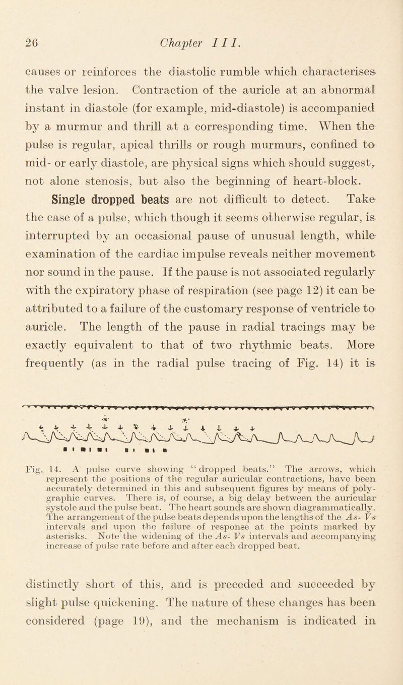 causes or reinforces the diastolic rumble which characterises- the valve lesion. Contraction of the auricle at an abnormal instant in diastole (for example, mid-diastole) is accompanied by a murmur and thrill at a corresponding time. When the pulse is regular, apical thrills or rough murmurs, confined to mid- or early diastole, are physical signs which should suggest, not alone stenosis, but also the beginning of heart-block. Single dropped beats are not difficult to detect. Take the case of a pulse, which though it seems otherwise regular, is interrupted by an occasional pause of unusual length, while examination of the cardiac impulse reveals neither movement nor sound in the pause. If the pause is not associated regularly with the expiratory phase of respiration (see page 12) it can be attributed to a failure of the customary response of ventricle to auricle. The length of the pause in radial tracings may be exactly equivalent to that of two rhythmic beats. More frequently (as in the radial pulse tracing of Fig. 14) it is 8 • a i * i hi m » ® Fig. 14. A pulse curve showing “ dropped beats.” The arrows, which represent the positions of the regular auricular contractions, have been accurately determined in this and subsequent figures by means of poly¬ graphic curves. There is, of course, a big delay between the auricular systole and the pulse beat. The heart sounds are shown diagrammatically. The arrangement of the pulse beats depends upon the lengths of the As- Vs- intervals and upon the failure of response at the points marked by asterisks. Note the widening of the As- Fs intervals and accompanying increase of pulse rate before and after each dropped beat. distinctly short of this, and is preceded and succeeded by slight pulse quickening. The nature of these changes has been considered (page 19), and the mechanism is indicated in