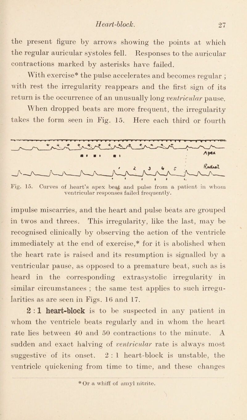 the present figure by arrows showing the points at which the regular auricular systoles fell. Responses to the auricular contractions marked by asterisks have failed. With exercise* the pulse accelerates and becomes regular ; with rest the irregularity reappears and the first sign of its return is the occurrence of an unusually long ventricular pause. When dropped beats are more frequent, the irregularity takes the form seen in Fig. 15. Here each third or fourth •—‘ i »' » r » r~ rrrT1 r 1 th » r w * yy ■ v-vrn. Ill i. Fig. 15. Curves of heart’s apex beat and pulse from a patient in whom ventricular responses failed frequently. impulse miscarries, and the heart and pulse beats are grouped in twos and threes. This irregularity, like the last, may be recognised clinically by observing the action of the ventricle immediately at the end of exercise,* for it is abolished when the heart rate is raised and its resumption is signalled by a ventricular pause, as opposed to a premature beat, such as is heard in the corresponding extrasystolic irregularity in similar circumstances ; the same test applies to such irregu¬ larities as are seen in Figs. 16 and 17. 2 : 1 heart-block is to be suspected in any patient in whom the ventricle beats regularly and in whom the heart rate lies between 40 and 50 contractions to the minute. A sudden and exact halving of ventricular rate is always most suggestive of its onset. 2 : 1 heart-block is unstable, the ventricle quickening from time to time, and these changes * Or a whiff of amyl nitrite.