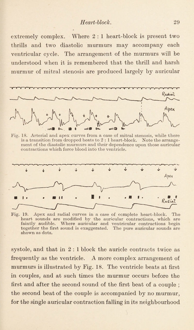 extremely complex. Where 2 : 1 heart-block is present two thrills and two diastolic murmurs may accompany each ventricular cycle. The arrangement of the murmurs will be understood when it is remembered that the thrill and harsh murmur of mitral stenosis are produced largely by auricular Fig. 18. Arterial and apex curves from a case of mitral stenosis, while there is a transition from dropped beats to 2 : 1 heart-block. Note the arrange¬ ment of the diastolic murmurs and their dependence upon those auricular contractions which force blood into the ventricle. Fig. 19. Apex and radial curves in a case of complete heart-block. The heart sounds are modified by the auricular contractions, which are faintly audible. Where auricular and ventricular contractions begin together the first sound is exaggerated. The pure auricular sounds are shown as dots. systole, and that in 2 : 1 block the auricle contracts twice as frequently as the ventricle. A more complex arrangement of murmurs is illustrated by Fig. 18. The ventricle beats at first in couples, and at such times the murmur occurs before the first and after the second sound of the first beat of a couple ; the second beat of the couple is accompanied by no murmur, for the single auricular contraction falling in its neighbourhood