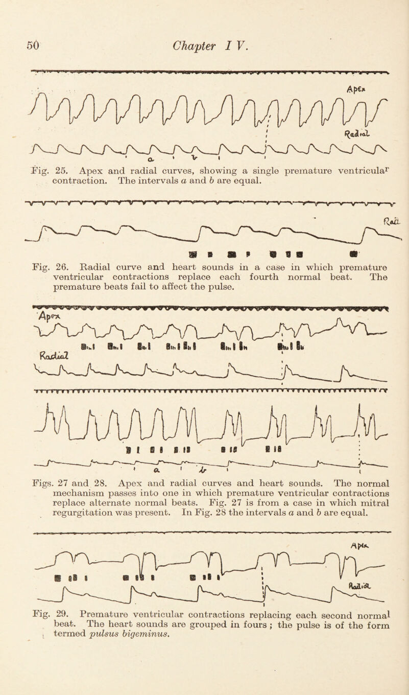 W H'f'll > H'> » » n i inn ii Fig. 25. Apex and radial curves, showing a single premature ventricula1' contraction. The intervals a and b are equal. -V**V—V 4—~V V V ’V vyv^ *» 1 v—r—v 1 y-~v - r* y ‘V”~—v-v***V”V 1 V' Fig. 26. Radial curve and heart sounds in a case in which premature ventricular contractions replace each fourth normal beat. The premature beats fail to affect the pulse. Figs. 27 and 28. Apex and radial curves and heart sounds. The normal mechanism passes into one in which premature ventricular contractions replace alternate normal beats. Fig. 27 is from a case in which mitral regurgitation was present. In Fig. 28 the intervals a and b are equal. Fig. 29. Premature ventricular contractions replacing each second normal beat. The heart sounds are grouped in fours ; the pulse is of the form , termed jpulsus bigeminus.
