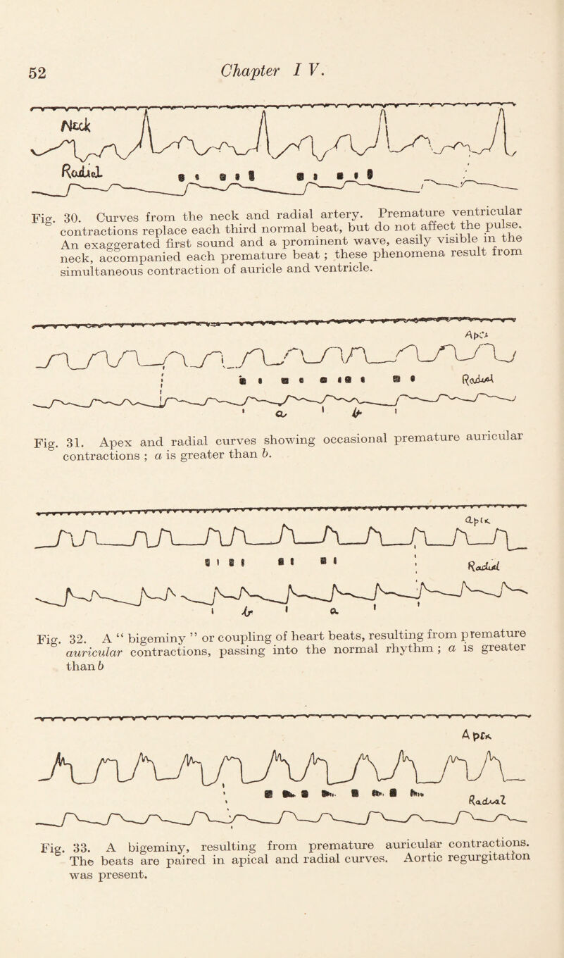 Fig. 30. Curves from the neck and radial artery. Premature ventricular contractions replace each third normal beat, but do not affect t e pu se. An exaggerated first sound and a prominent wave, easily visible in the neck, accompanied each premature beat; these phenomena result from simultaneous contraction of auricle and ventricle. Fig. 31. Apex and radial curves showing occasional premature auricular contractions ; a is greater than b. _jaa_n_A AA SIS! a_a_ Fig. 32. A “ bigeminy ” or coupling of heart beats, resulting from premature auricular contractions, passing into the normal rhythm ; a is greater than 6 y—y-y—Y y—y—V~y » V » 0 » — ¥ V •* » » » -Vlf—V * v ■ V '» * » ¥ V V * ■ V 1 V Apr* Fig. 33. A bigeminy, resulting from premature auricular contractions. C* The beats are paired in apical and radial curves. Aortic regurgitation was present.
