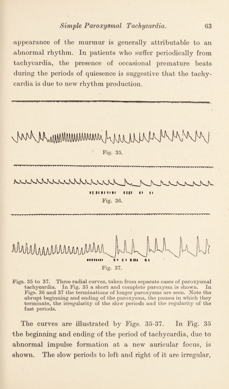 appearance of the murmur is generally attributable to an abnormal rhythm. In patients who suffer periodically from tachycardia, the presence of occasional premature beats during the periods of quiesence is suggestive that the tachy¬ cardia is due to new rhythm production. _fN. jS^jS^ fs_n_[S^. 81 51 BI Bill SIS! I! || Fig. 36. ■vvrrnnrirrvT'nrrrnr IN 'x/ NJ Ni ■f Siam « 5 I Sill Cl Fig. 37. Figs. 35 to 37. Three radial curves, taken from separate cases of paroxysmal tachycardia. In Fig. 35 a short and complete paroxysm is shown. In Figs. 36 and 37 the terminations of longer paroxysms are seen. Note the abrupt beginning and ending of the paroxysms, the pauses in which they terminate, the irregularity of the slow periods and the regularity of the fast periods. The curves are illustrated by Figs. 35-37. In Fig. 35 the beginning and ending of the period of tachycardia, due to abnormal impulse formation at a new auricular focus, is shown. The slow periods to left and right of it are irregular,