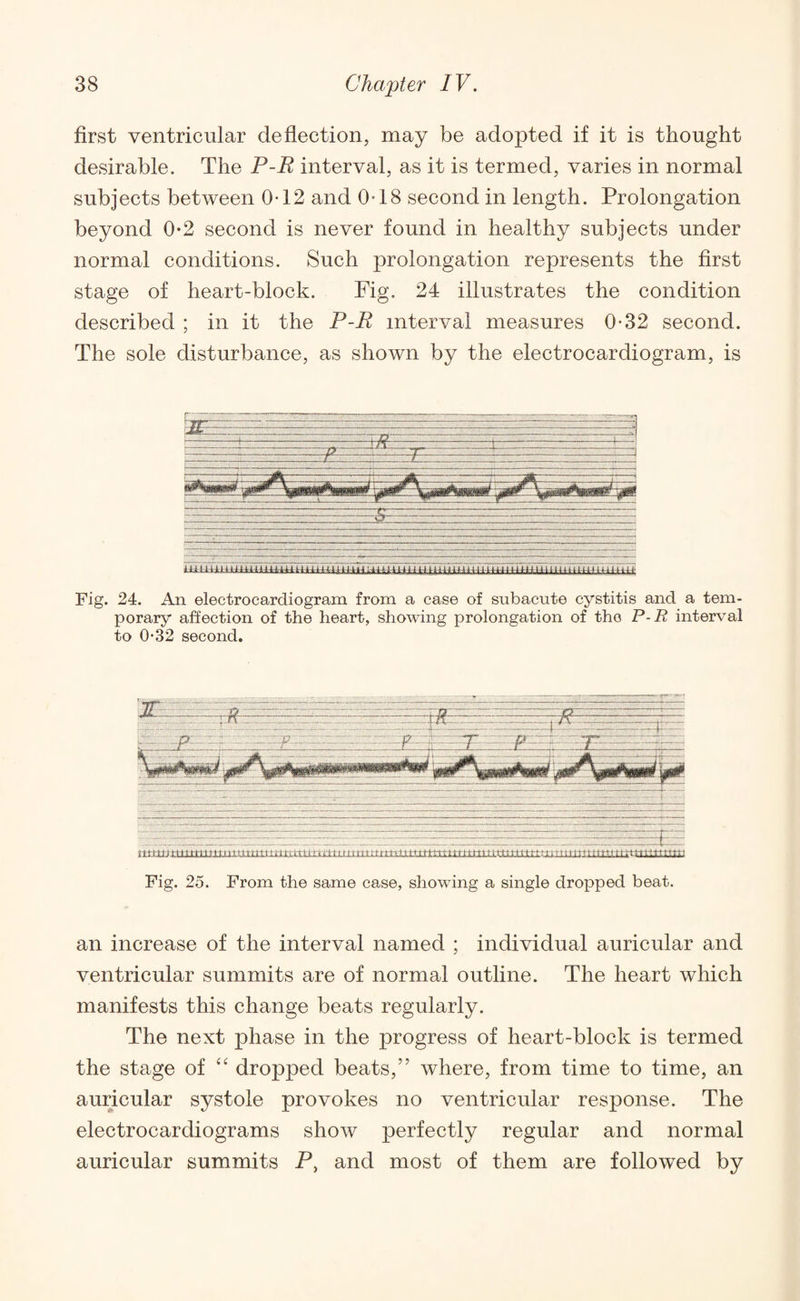 first ventricular deflection, may be adopted if it is thought desirable. The P-R interval, as it is termed, varies in normal subjects between 0-12 and 0-18 second in length. Prolongation beyond 0-2 second is never found in healthy subjects under normal conditions. Such prolongation represents the first stage of heart-block. Fig. 24 illustrates the condition described ; in it the P-R interval measures 0-32 second. The sole disturbance, as shown by the electrocardiogram, is Fig. 24. An electrocardiogram from a case of subacute cystitis and a tem¬ porary affection of the heart, showing prolongation of the P-R interval to 032 second. an increase of the interval named ; individual auricular and ventricular summits are of normal outline. The heart which manifests this change beats regularly. The next phase in the progress of heart-block is termed the stage of “ dropped beats,” where, from time to time, an auricular systole provokes no ventricular response. The electrocardiograms show perfectly regular and normal auricular summits P, and most of them are followed by