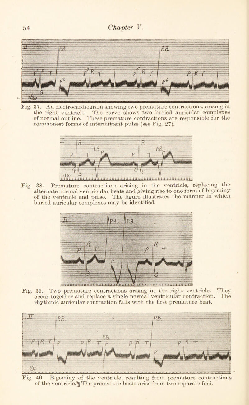 Fig. 37. An electrocardiogram showing two premature contractions, arising in the right ventricle. The curve shows two buried auricular complexes of normal outline. These premature contractions are responsible for the commonest forms of intermittent pulse (see Fig. 27). Fig. 38. Premature contractions arising in the ventricle, replacing the alternate normal ventricular beats and giving rise to one form of bigeminy of the ventricle and pulse. The figure illustrates the manner in which buried auricular complexes may be identified. Fig. 39. Two premature contractions arising in the right ventricle, occur together and replace a single normal ventricular contraction, rhythmic auricular contraction falls with the first premature beat. They The Fig. 40. Bigeminy of the ventricle, resulting from premature contractions of the ventricle.'^ The premature beats arise from two separate foci.