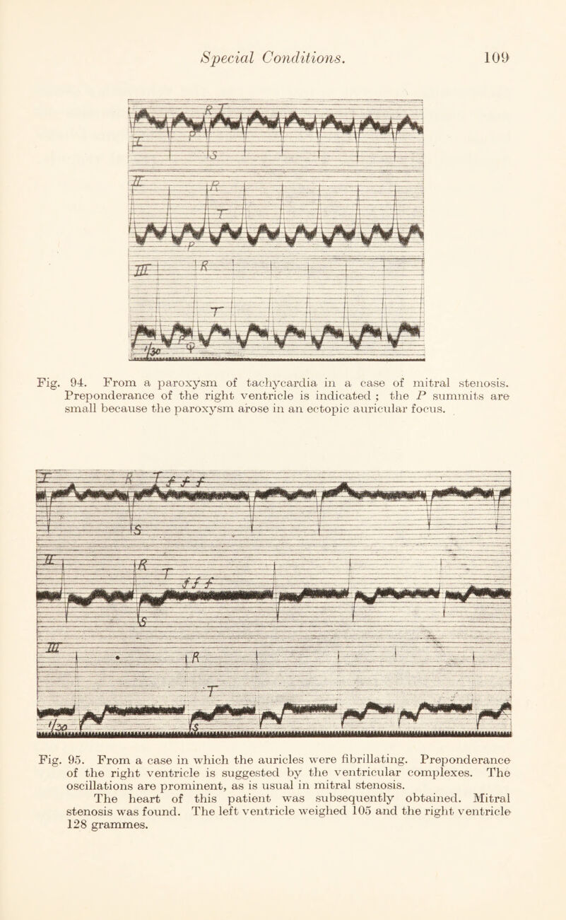 Fig. 94. From a paroxysm of tachycardia in a case of mitral stenosis. Preponderance of the right ventricle is indicated ; the P summits are small because the paroxysm arose in an ectopic auricular focus. Fig. 95. From a case in which the auricles were fibrillating. Preponderance of the right ventricle is suggested by the ventricular complexes. The oscillations are prominent, as is usual in mitral stenosis. The heart of this patient was subsequently obtained. Mitral stenosis was found. The left ventricle weighed 105 and the right ventricle^ 128 grammes.