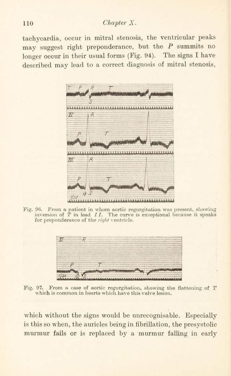 tachycardia, occur in mitral stenosis, the ventricular peaks may suggest right preponderance, but the P summits no longer occur in their usual forms (Fig. 94). The signs I have described may lead to a correct diagnosis of mitral stenosis, Fig. 96. From a patient in whom aortic regurgitation was present, showing inversion of T in lead 11. The curve is exceptional because it speaks for preponderance of the right ventricle. Fig. 97. From a case of aortic regurgitation, showing the flattening of T which is common in hearts which have this valve lesion. which without the signs would be unrecognisable. Especially is this so when, the auricles being in fibrillation, the presystolic murmur fails or is replaced by a murmur falling in early