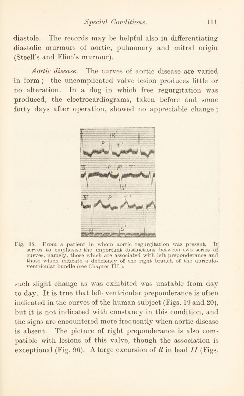 diastole. The records may be helpful also in differentiating diastolic murmurs of aortic, pulmonary and mitral origin (Steell’s and FlinFs murmur). Aortic disease. The curves of aortic disease are varied in form ; the uncomplicated valve lesion produces little or no alteration. In a dog in which free regurgitation was produced, the electrocardiograms, taken before and some forty days after operation, showed no appreciable change ; Fig. 98. From a patient in whom aortic regurgitation was present. It serves to emphasise the important distinctions between two series of curves, namely, those which are associated with left preponderance and those which indicate a deficiency of the right branch of the auriculo ventricular bundle (see Chapter III.). such slight change as was exhibited was unstable from day to day. It is true that left ventricular preponderance is often indicated in the curves of the human subject (Figs. 19 and 20), but it is not indicated with constancy in this condition, and the signs are encountered more frequently when aortic disease is absent. The picture of right preponderance is also com¬ patible with lesions of this valve, though the association is exceptional (Fig. 96). A large excursion of R in lead II (Figs.