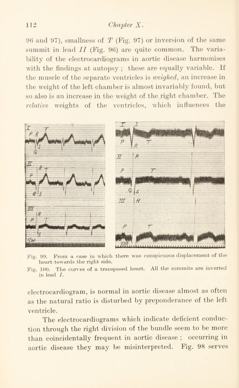 4 96 and 97), smallness of T (Fig. 97) or inversion of the same summit in lead II (Fig. 96) are quite common. The varia¬ bility of the electrocardiograms in aortic disease harmonises with the findings at autopsy ; these are equally variable. If the muscle of the separate ventricles is weighed, an increase in the weight of the left chamber is almost invariably found, but so also is an increase in the weight of the right chamber. The relative weights of the ventricles, which influences the —A--A —---J- - -.- — -jzt If? j ’ r . » :.' ' .■  ' ~ -- • • • .it' p'4-'--: • - v i '  ] f • J ^ 1 ti I Fig. 99. From a case in which there was conspicuous displacement of the heart towards the right side. Fig. 100. The curves of a transposed heart. All the summits are inverted in lead I. electrocardiogram, is normal in aortic disease almost as often as the natural ratio is disturbed by preponderance of the left ventricle. The electrocardiograms which indicate deficient conduc¬ tion through the right division of the bundle seem to be more than coincidentally frequent in aortic disease ; occurring in aortic disease they may be misinterpreted. Fig. 98 serves