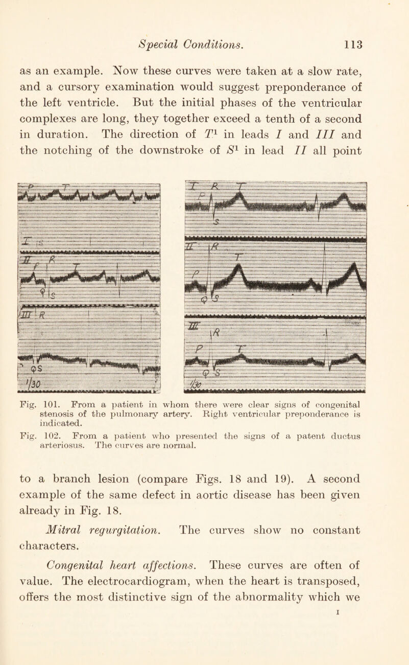 as an example. Now these curves were taken at a slow rate, and a cursory examination would suggest preponderance of the left ventricle. But the initial phases of the ventricular complexes are long, they together exceed a tenth of a second in duration. The direction of T1 in leads I and III and the notching of the downstroke of S1 in lead II all point Fig. 101. From a patient in whom there were clear signs of congenital stenosis of the pulmonary artery. Right ventricular preponderance is indicated. Fig. 102. From a patient who presented the signs of a patent ductus arteriosus. The curves are normal. to a branch lesion (compare Figs. 18 and 19). A second example of the same defect in aortic disease has been given already in Fig. 18. Mitral regurgitation. The curves show no constant characters. Congenital heart affections. These curves are often of value. The electrocardiogram, when the heart is transposed, offers the most distinctive sign of the abnormality which we